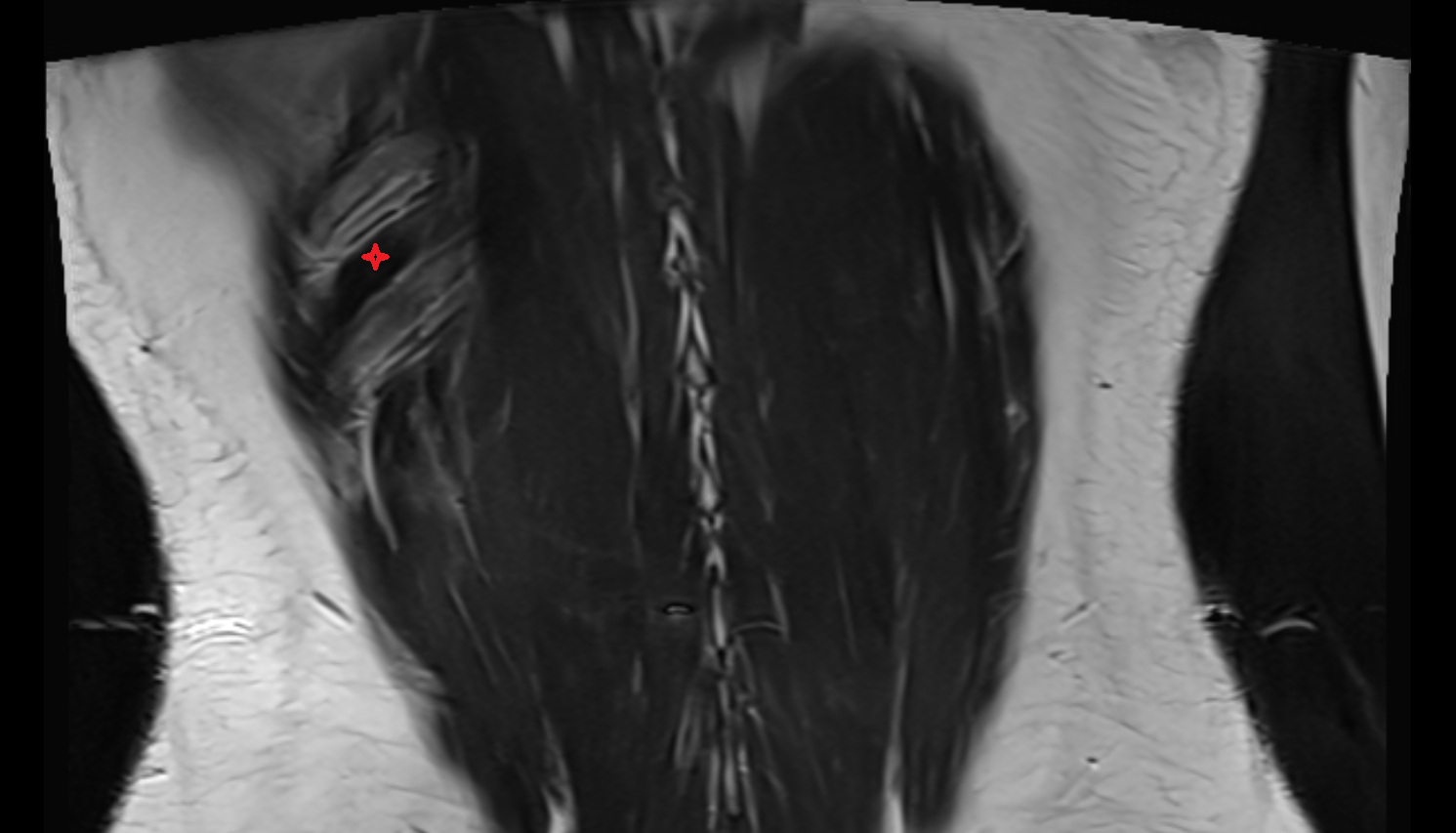 Intercostal muscles  MRIcoronal  image anatomy  image -img-00000-00000