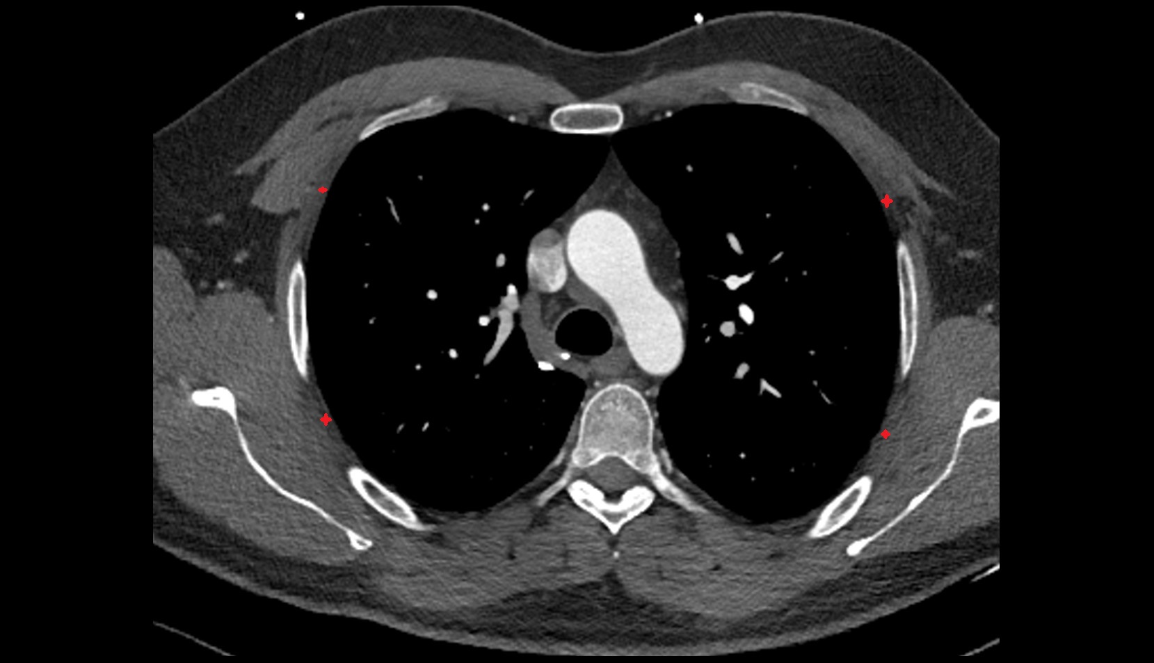 Intercostal muscles ct axial image