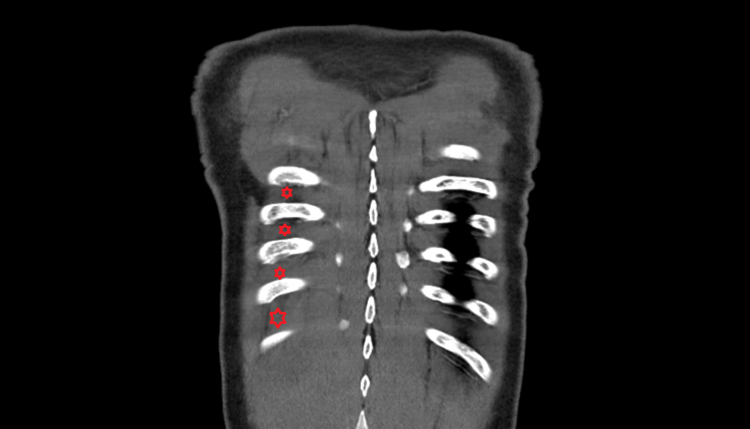 Intercostal space CT Anatomy, Location and Imaging Appearance  -img-00000-00000