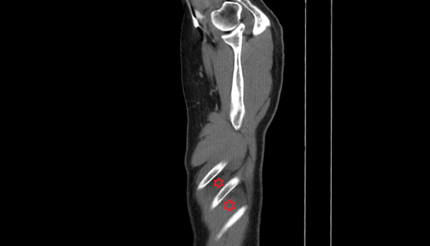 Intercostal space CT Anatomy, Location and Imaging Appearance  -img-00000-00000_00001