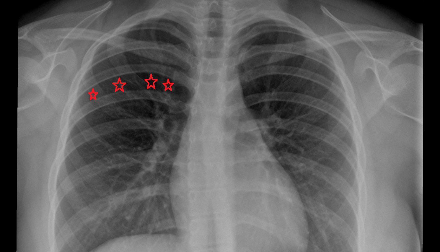 Intercostal space X ray Anatomy, Location and Imaging Appearance  -img-00000-00000