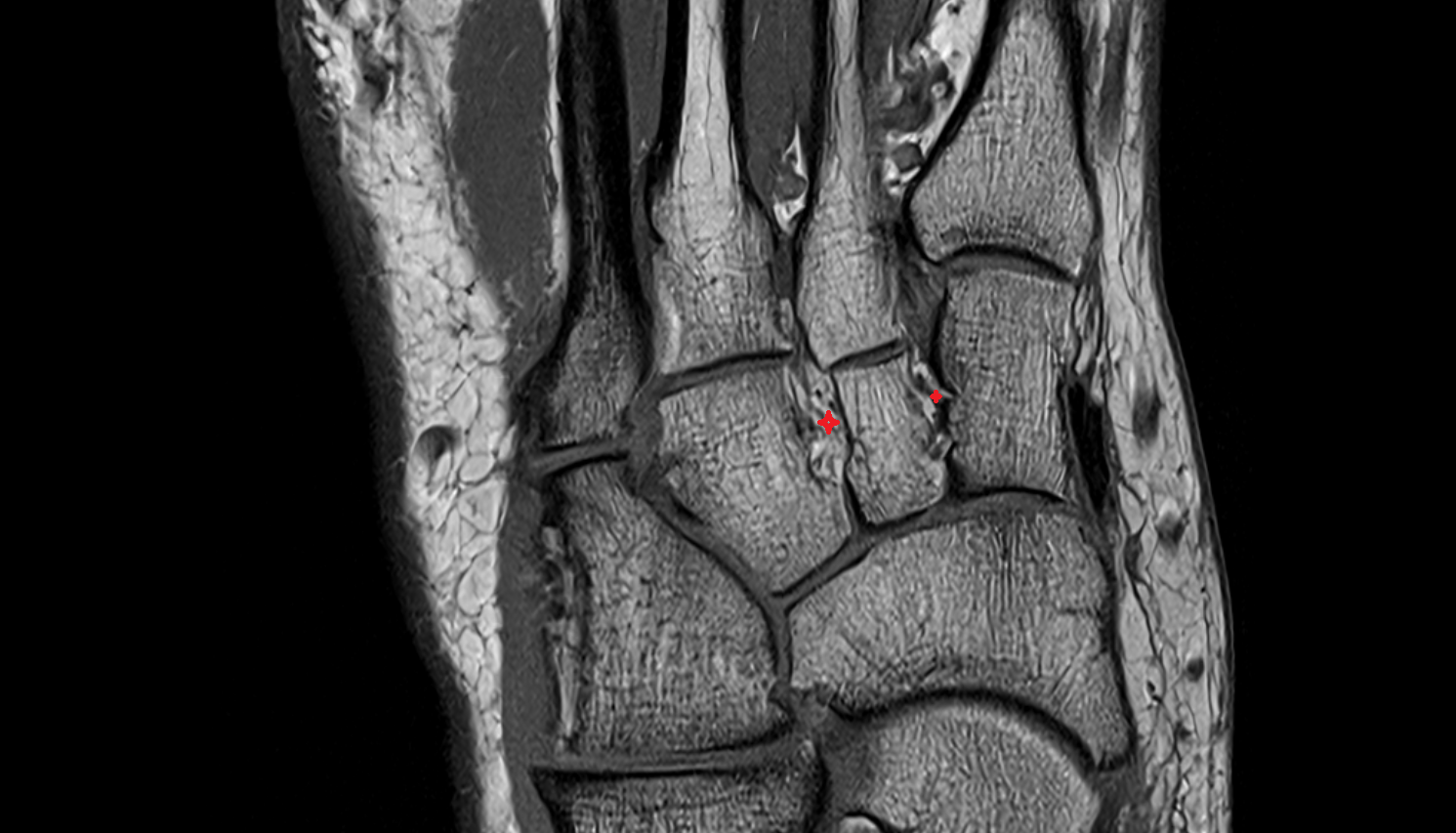 Intercuneiform ligaments axial cross sectional anatomy 3T MRI AI enhanced radiology image-img-00000-00000