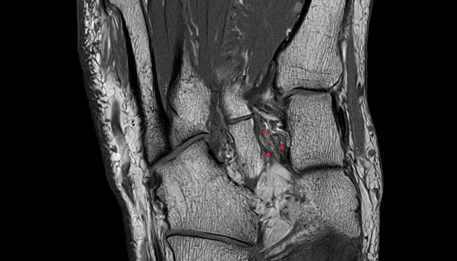 Intercuneiform ligaments axial cross sectional anatomy 3T MRI AI enhanced radiology image-img-00000-00000_00001