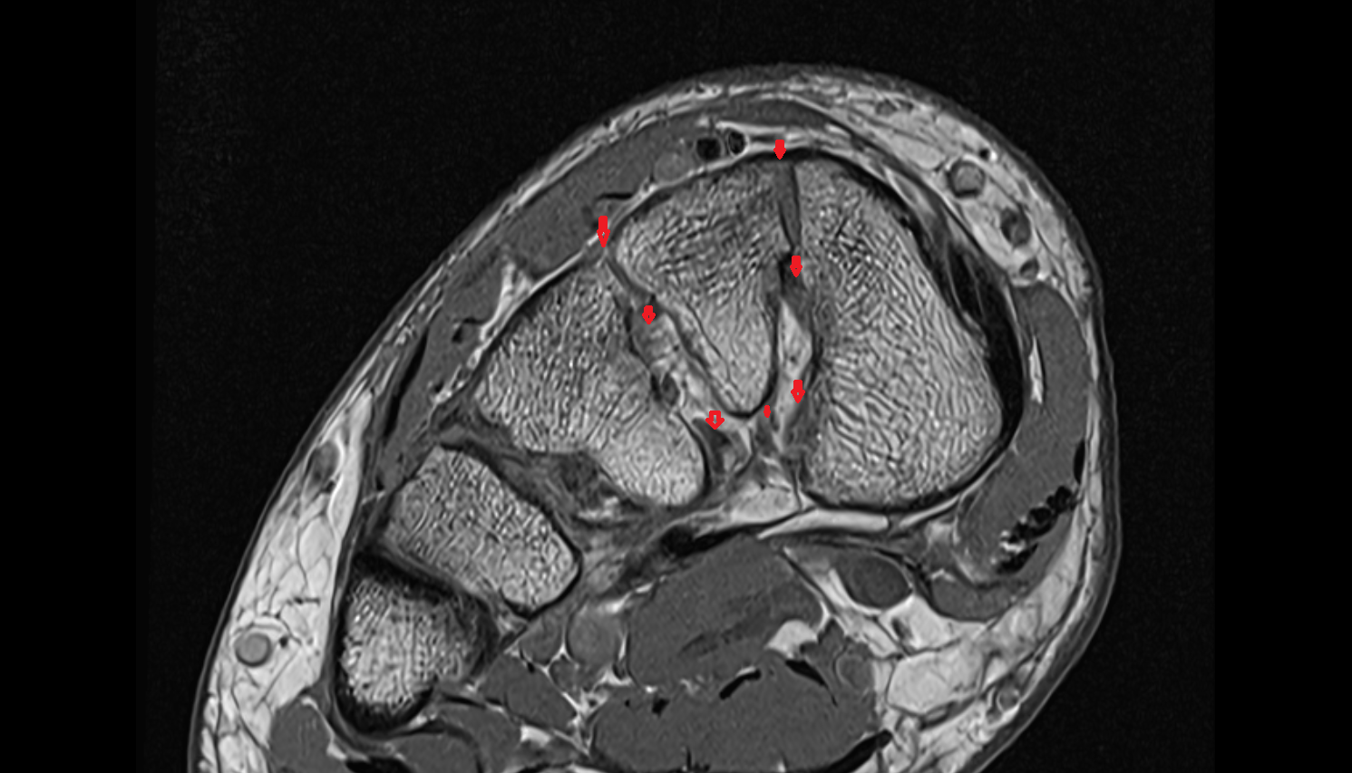 Intercuneiform ligaments axial cross sectional anatomy 3T MRI AI enhanced radiology image-img-00000-00000_00002