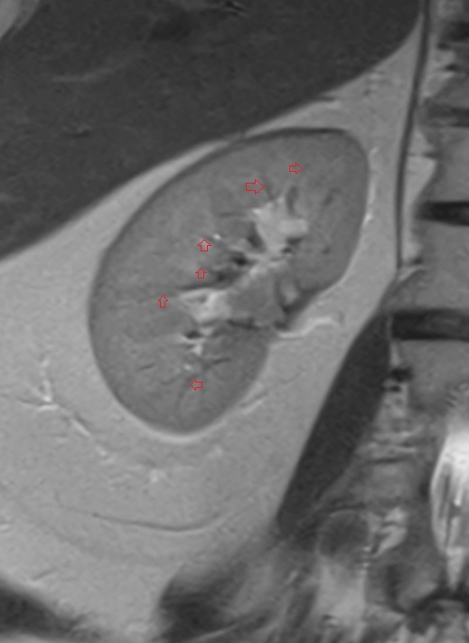 Interlobar arteries (kidney) MRI coronal anatomy  image -img-00000-00000