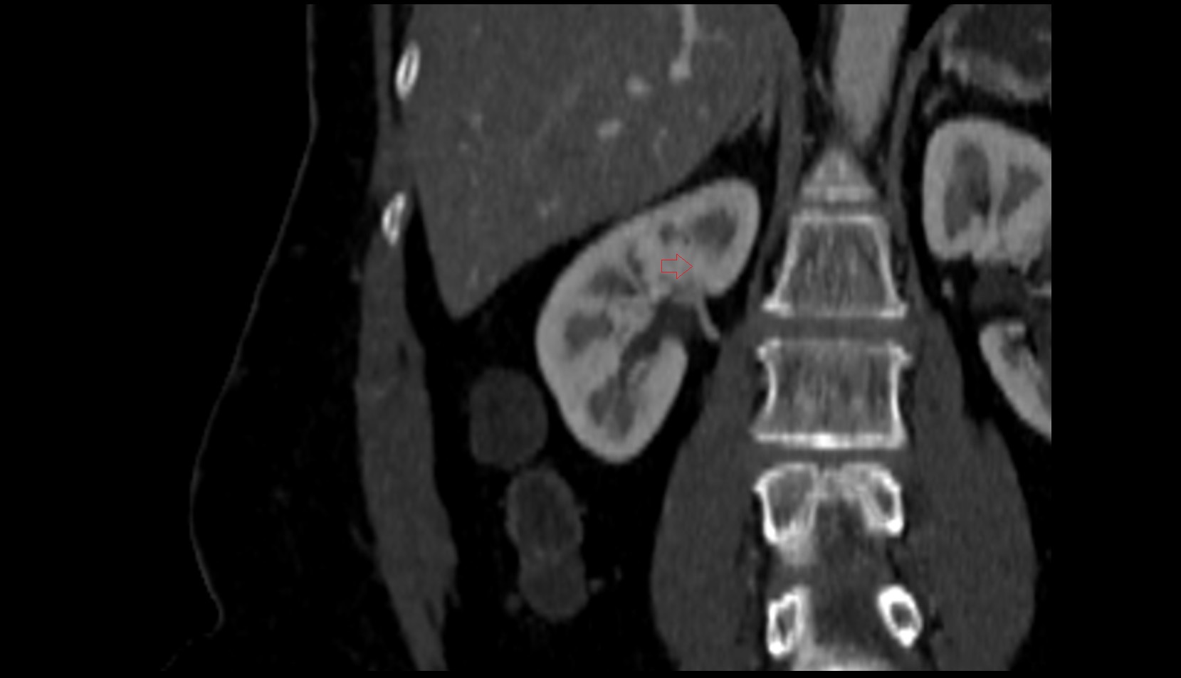 Interlobar arteries (kidney) ct coronal image 1