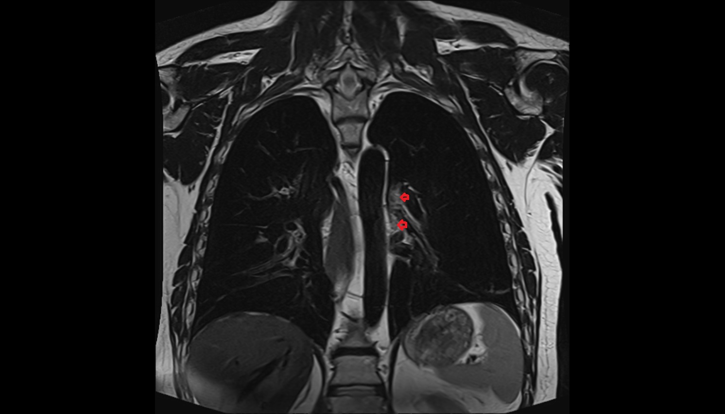 Interlobar  lymph nodes  anatomy MRI coronal  image -img-00000-00000