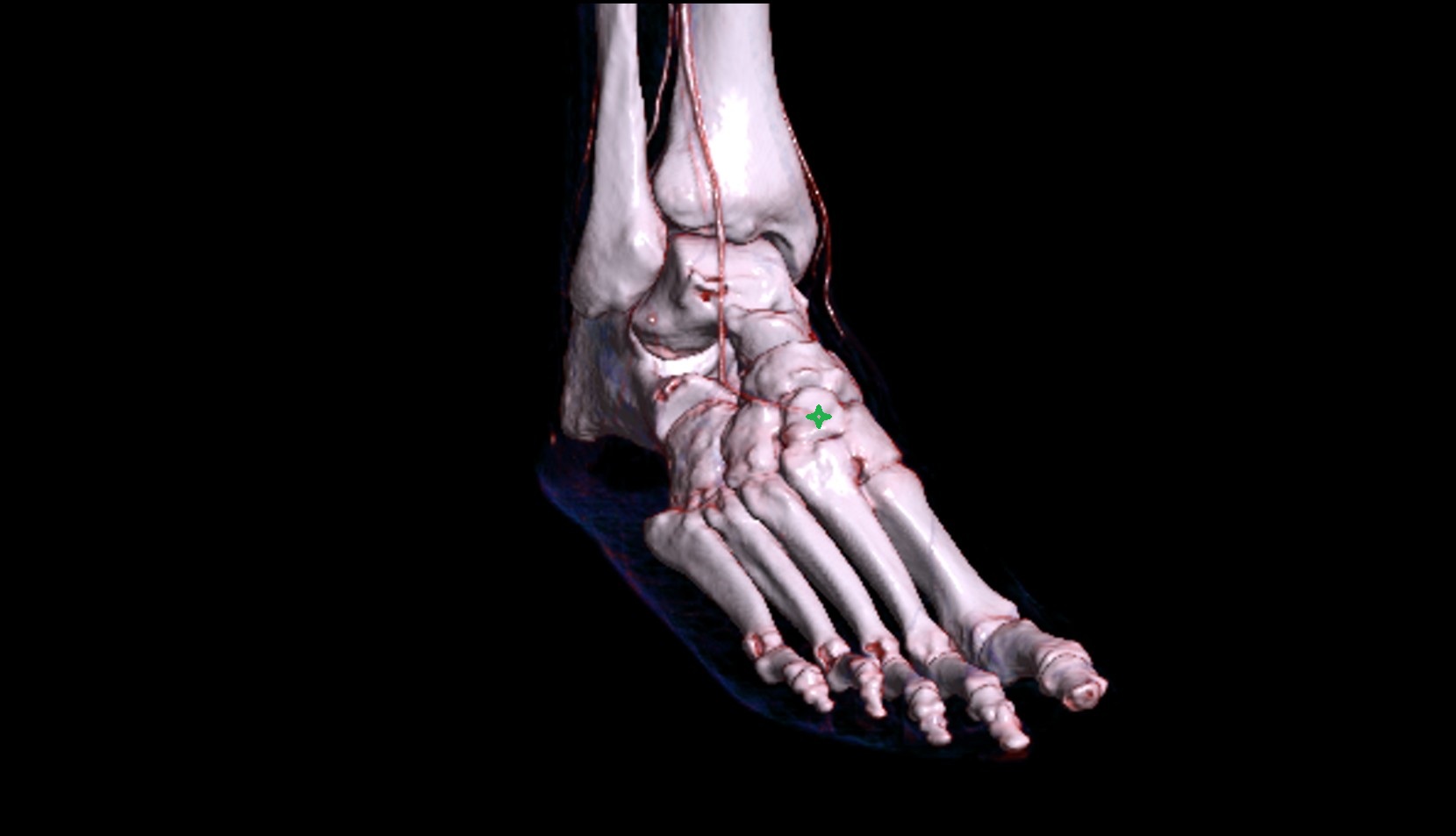 Intermediate cuneiform bone 3d