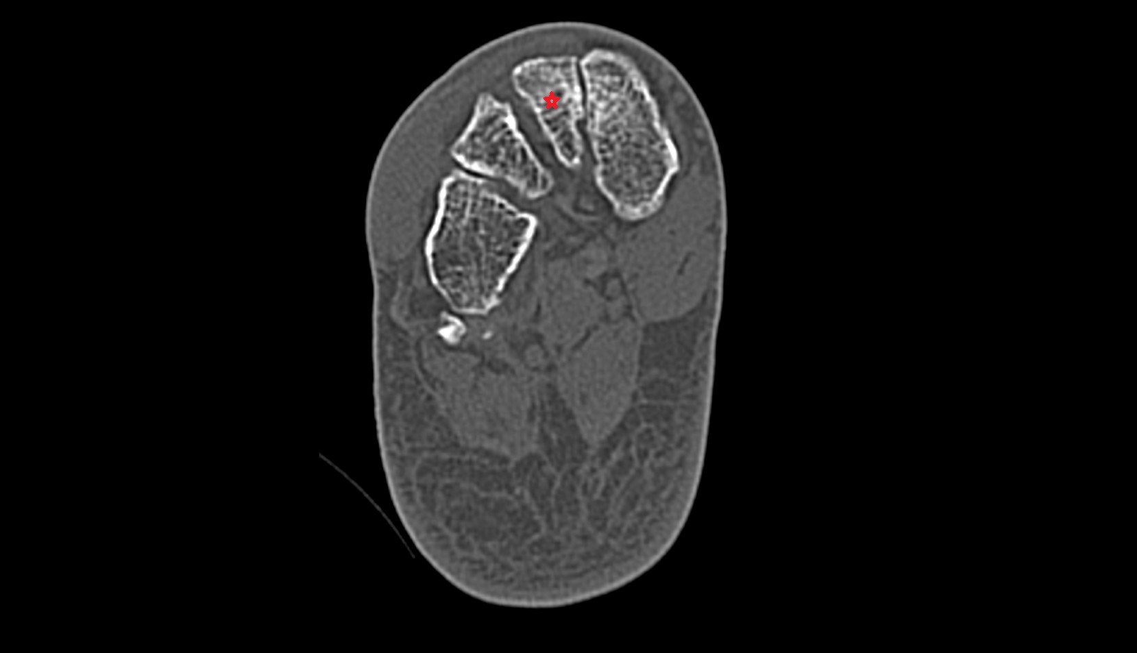 Intermediate cuneiform bone ct axial