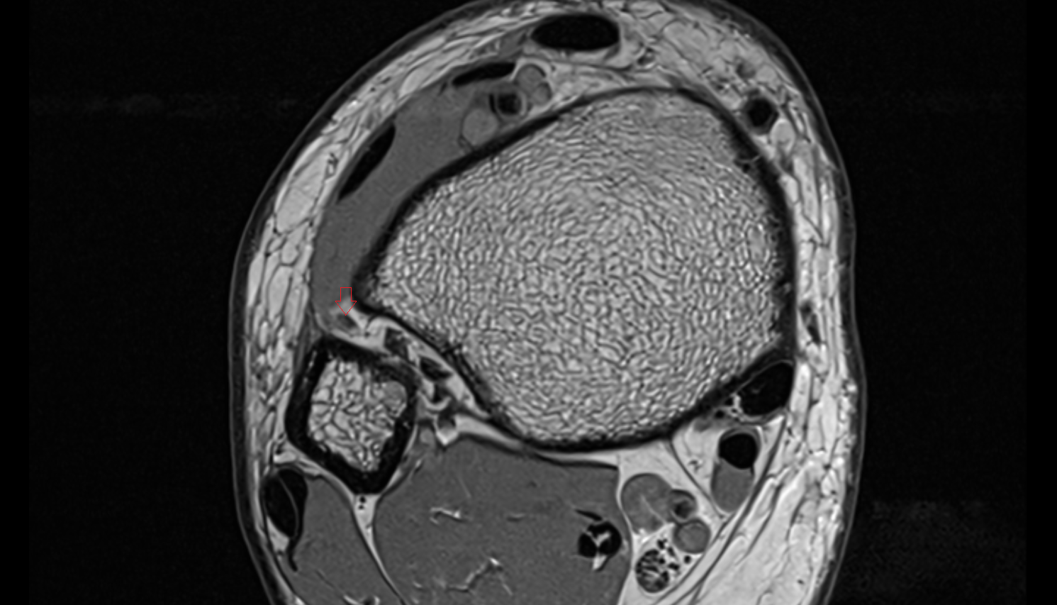Intermediate dorsal cutaneous nerve axial cross sectional anatomy 3T MRI AI enhanced radiology image-img-00000-00000
