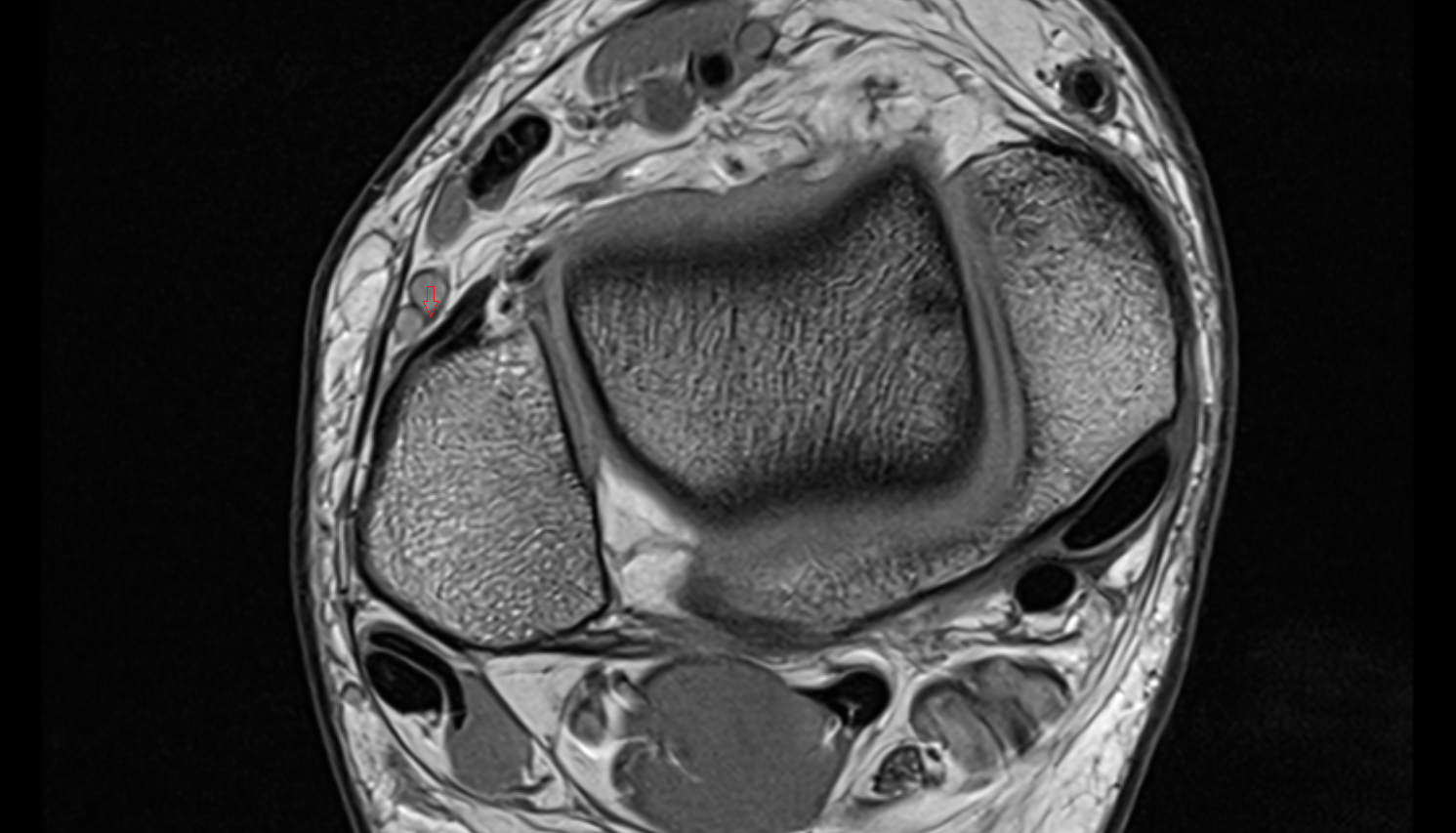 Intermediate dorsal cutaneous nerve axial cross sectional anatomy 3T MRI AI enhanced radiology image-img-00000-00000_00001