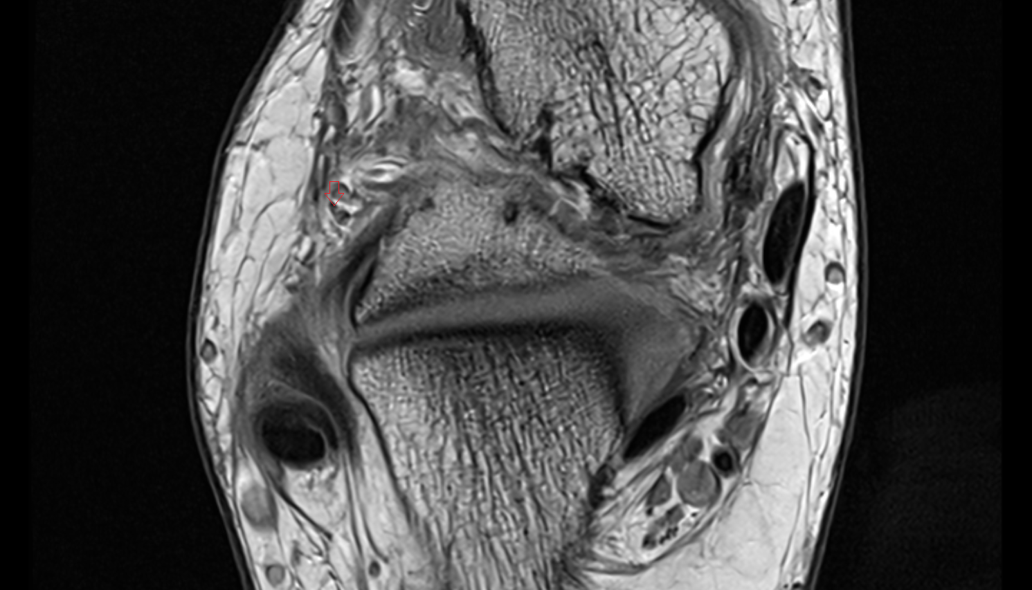 Intermediate dorsal cutaneous nerve axial cross sectional anatomy 3T MRI AI enhanced radiology image-img-00000-00000_00003
