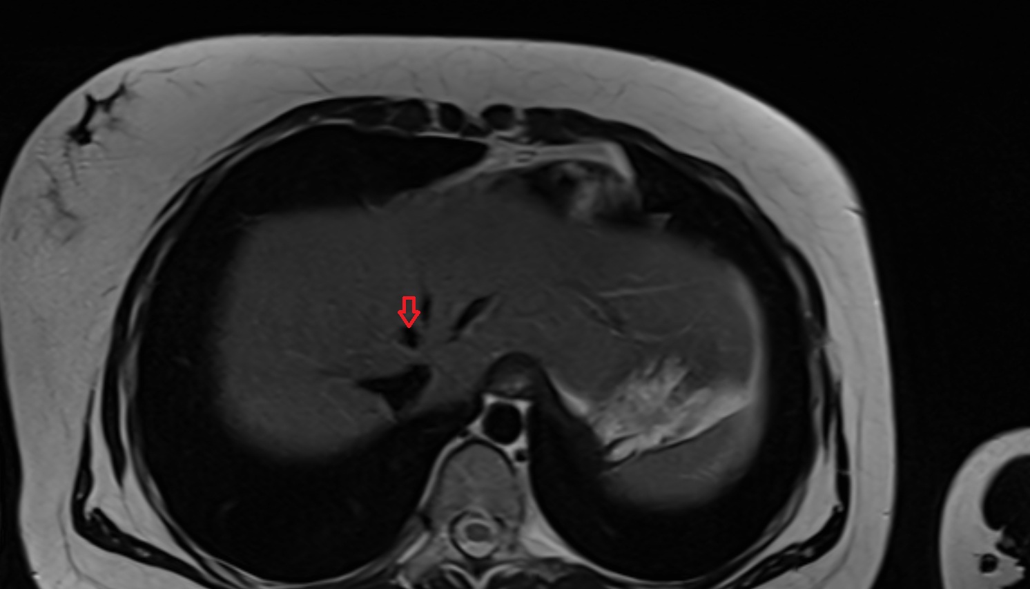 Intermediate hepatic vein anatomy MRI axial  image -img-00000-00000_00002