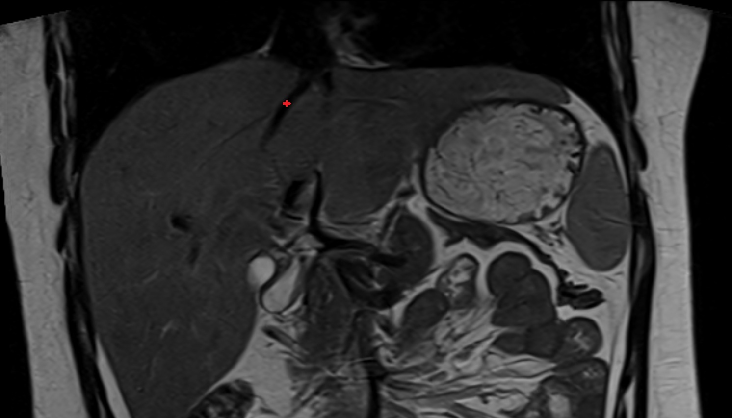 Intermediate hepatic vein anatomy MRI coronal  image -img-00000-00000