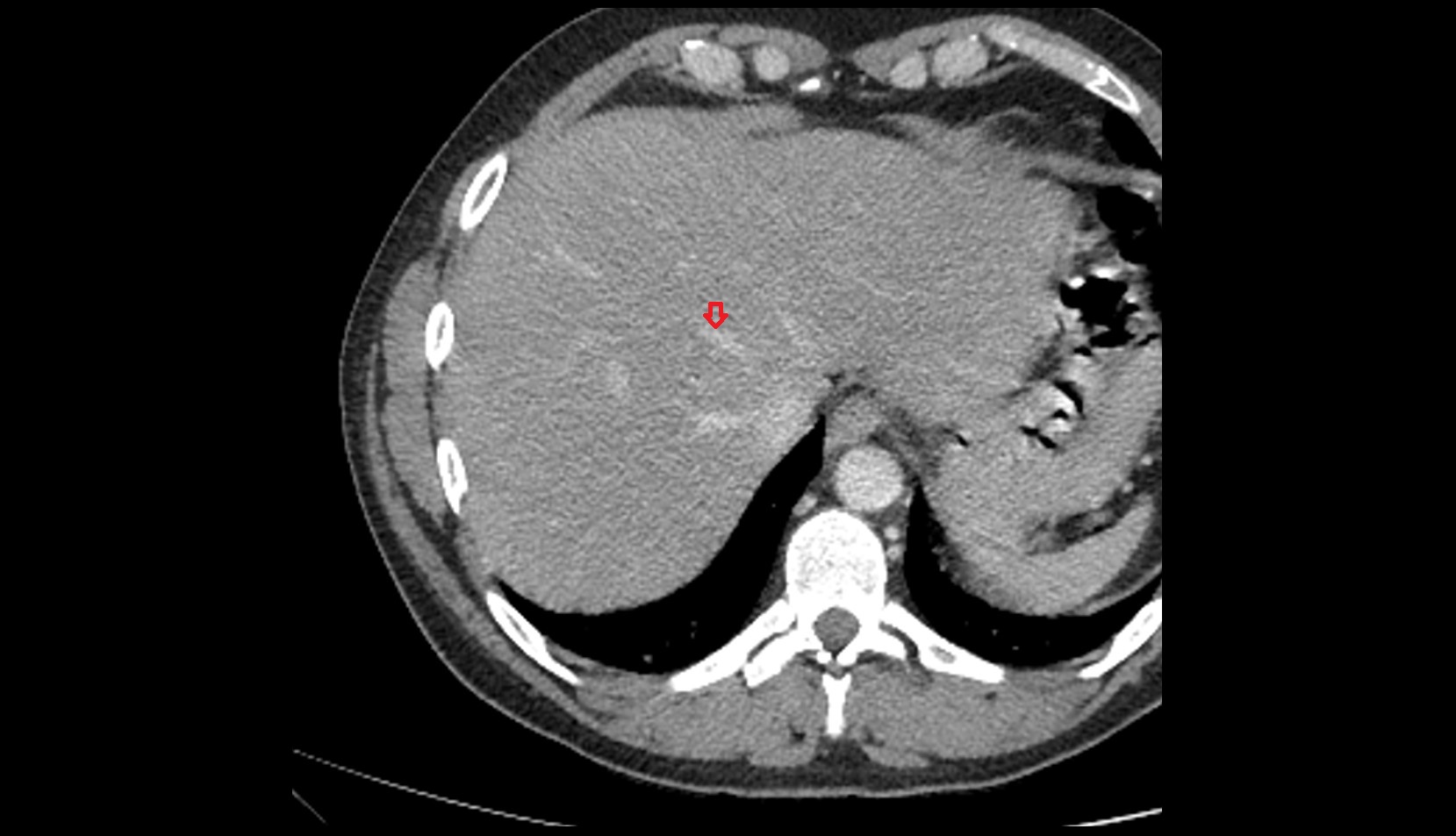 Intermediate hepatic vein ct axial