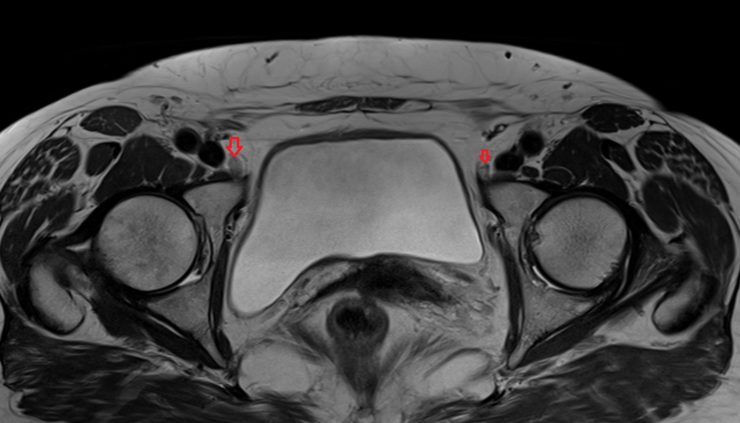Intermediate lacunar external iliac lymph nodes  MRI axial  anatomy  image-img-00000-00000