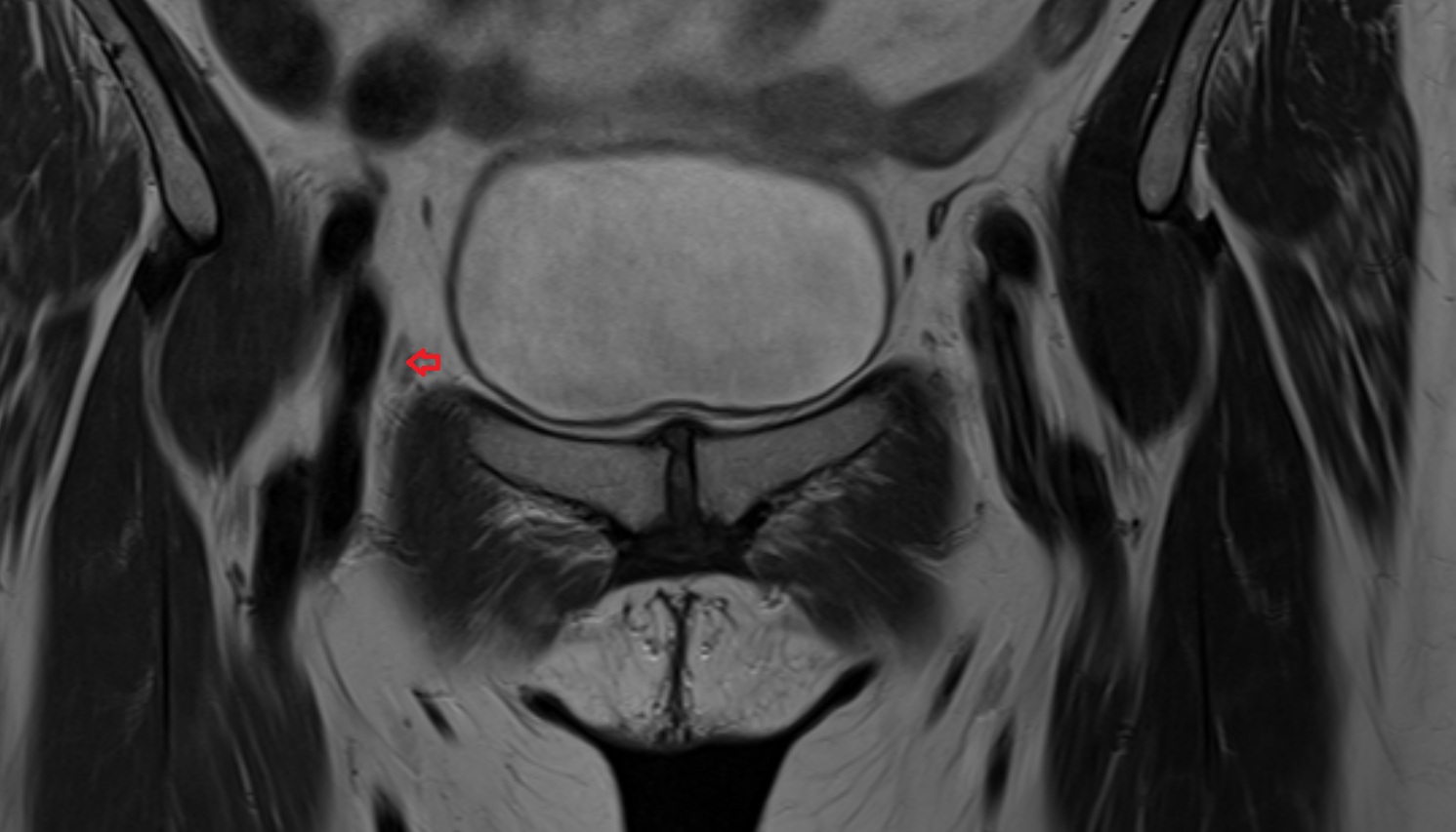 Intermediate lacunar external iliac lymph nodes  MRI coronal  anatomy  image-img-00000-00000