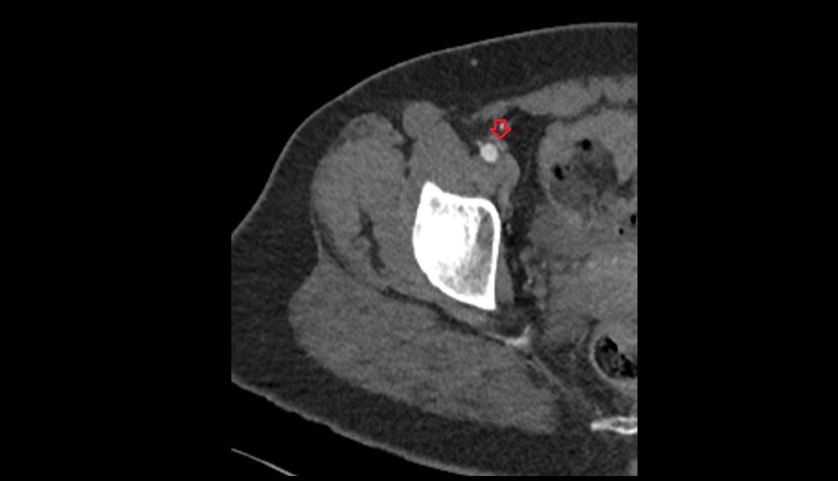 Intermediate lacunar external iliac lymph nodes ct
