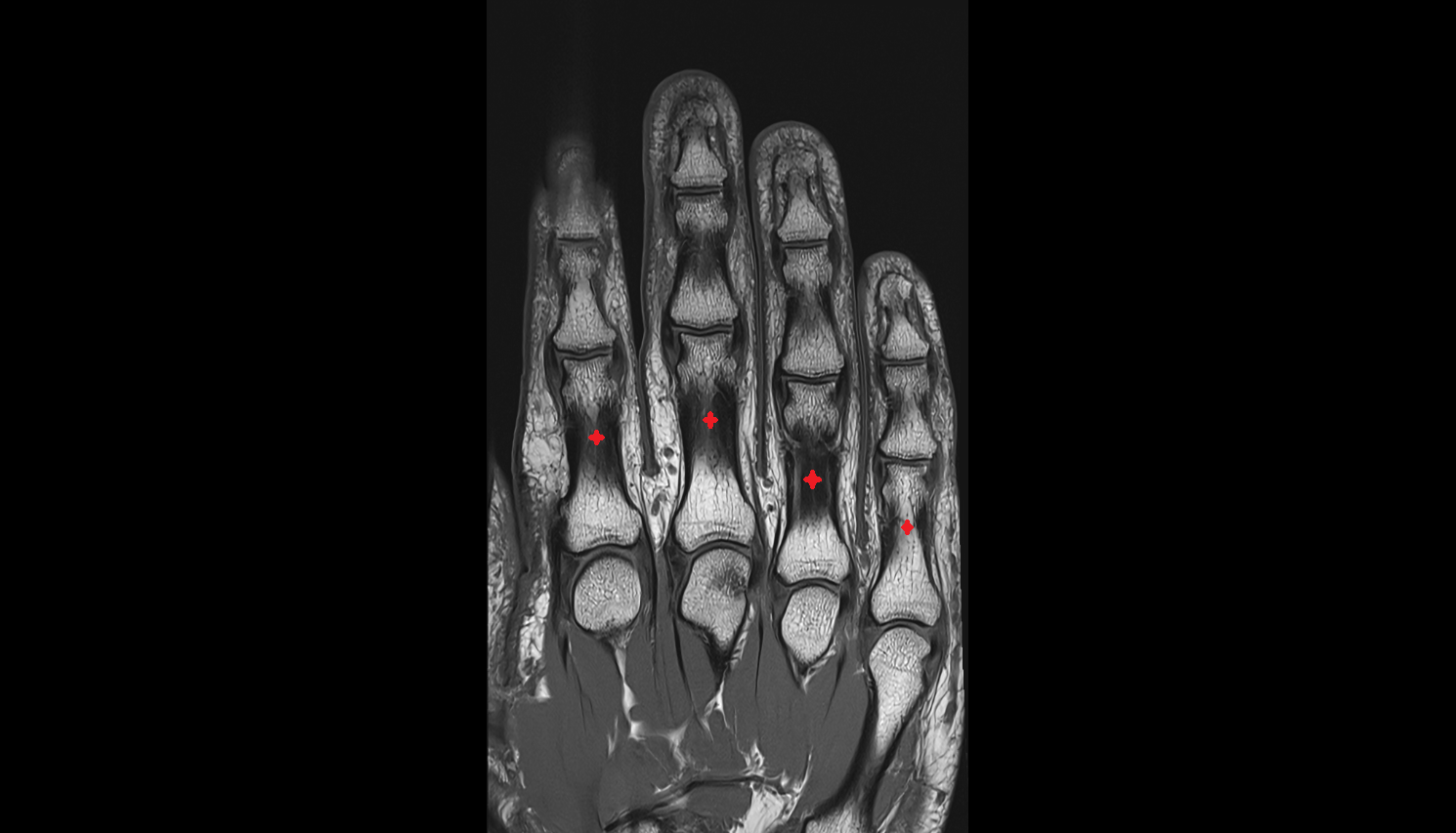 Intermediate phalanx  MRI CORONAL image-img-00000-00000