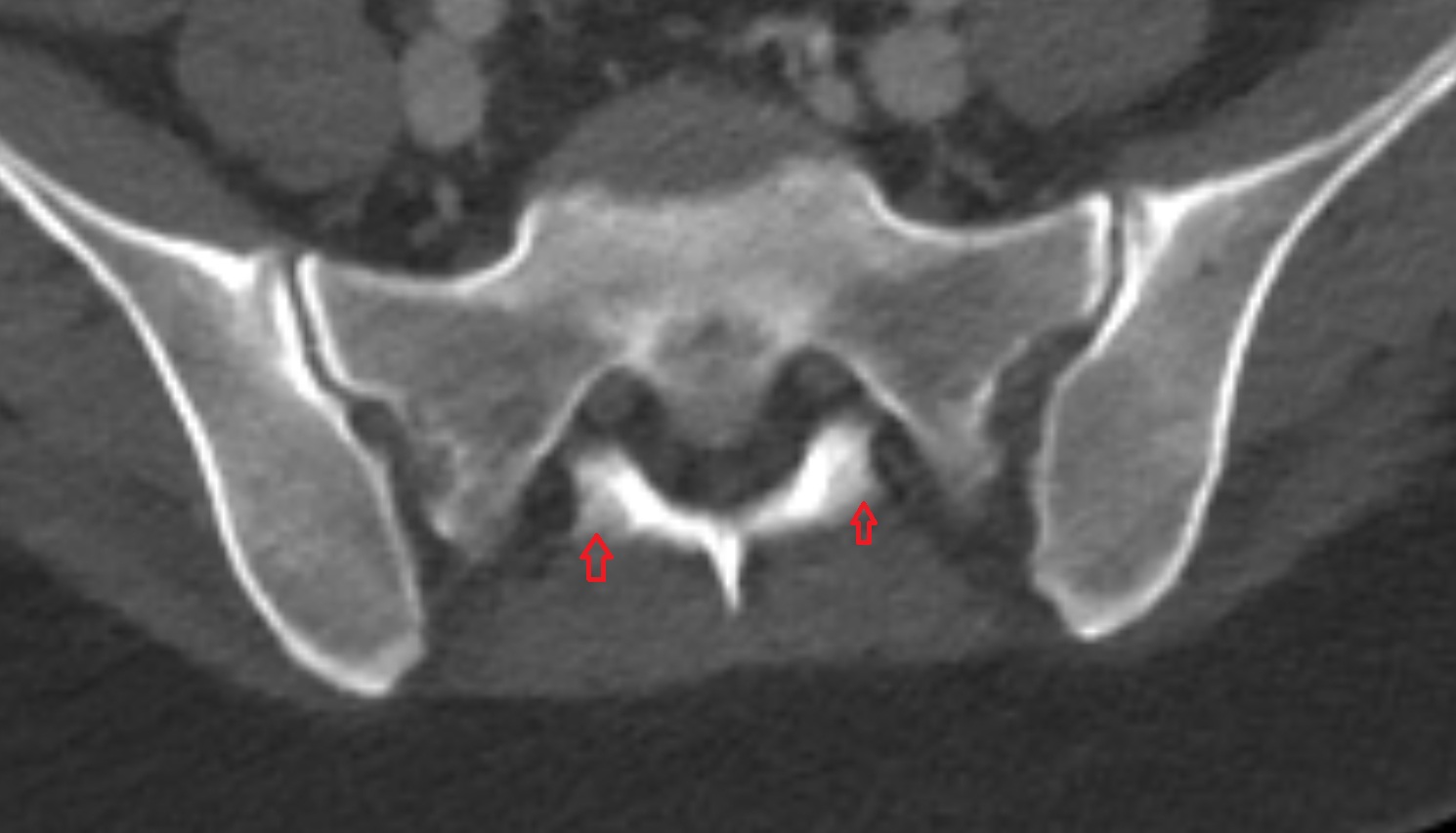 Intermediate sacral crest  ct  axial   anatomy  image-img-00000-00000