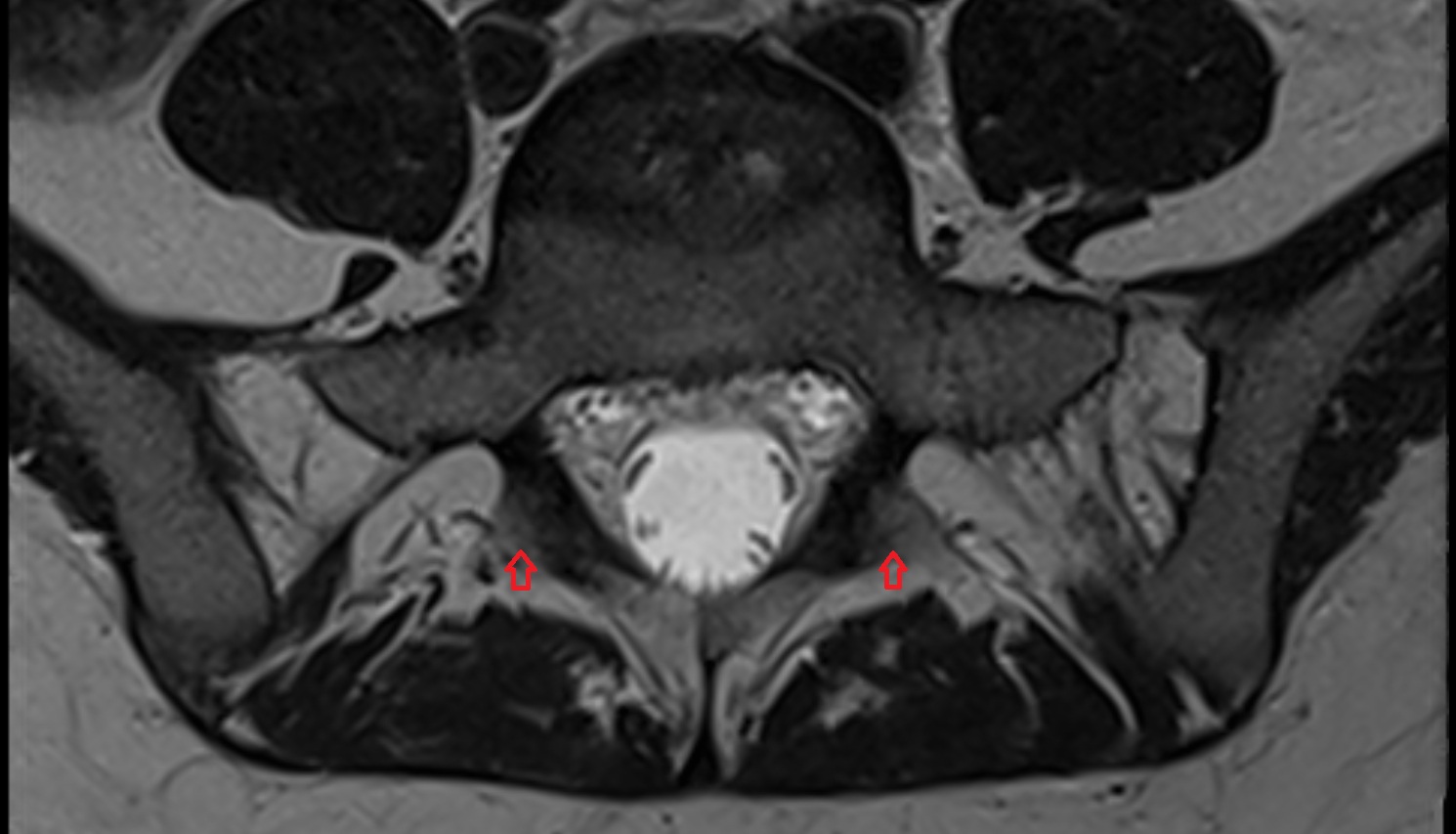 Intermediate sacral crest  mri axial  anatomy  image-img-00000-00000