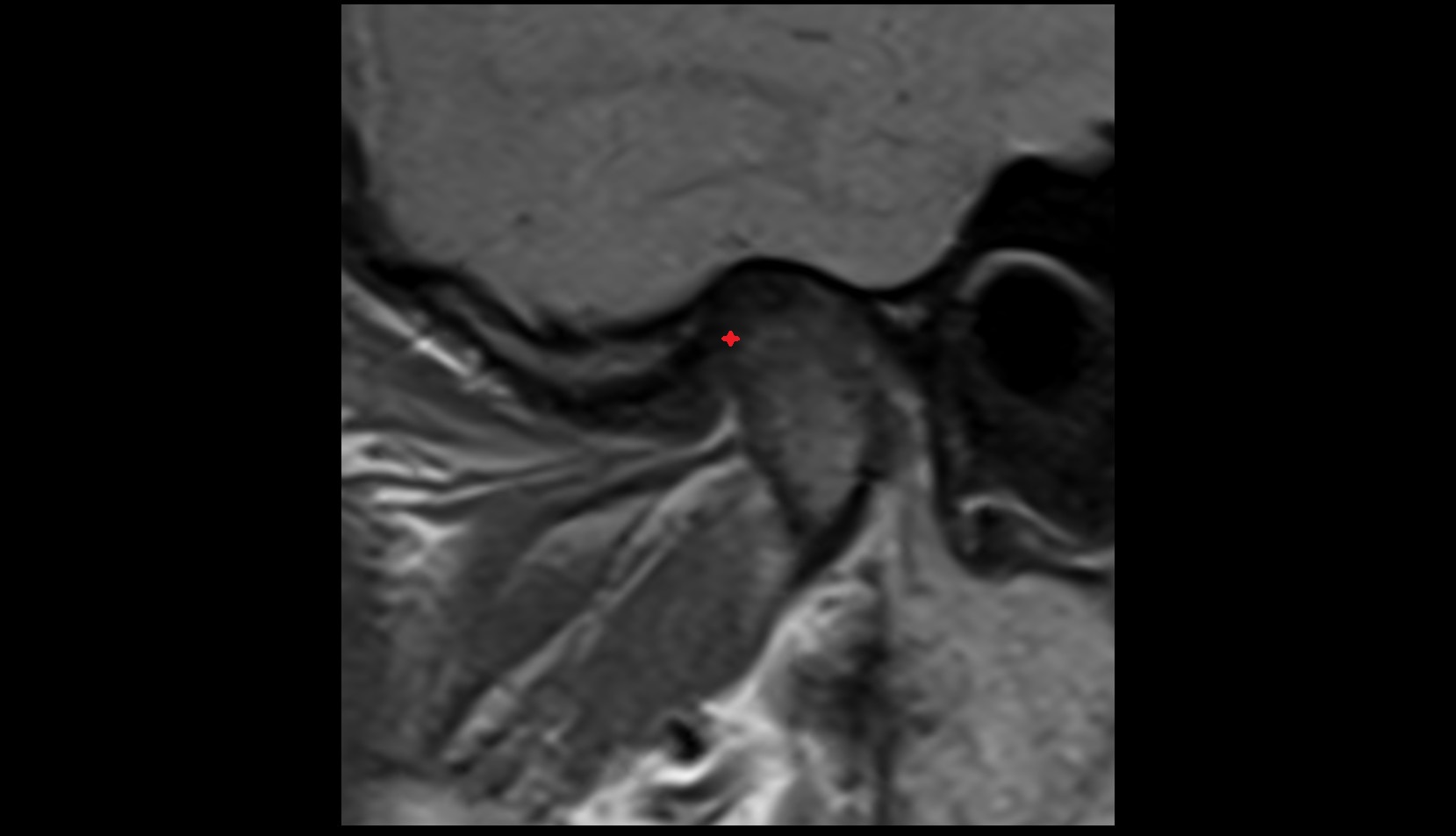 Intermediate zone of articular disc