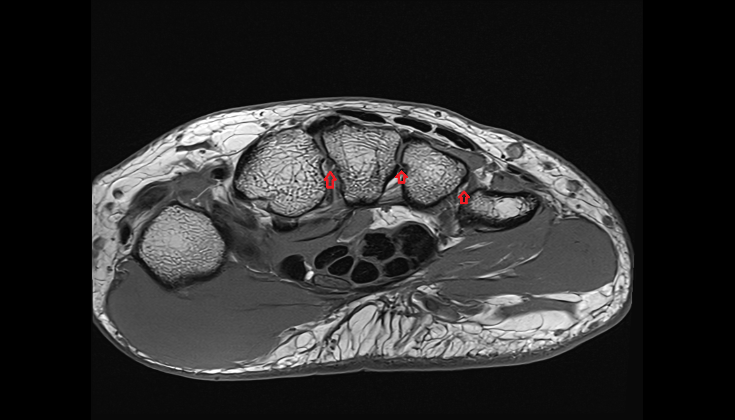 Intermetacarpal joints mri  anatomy labelled image-img-00000-00000