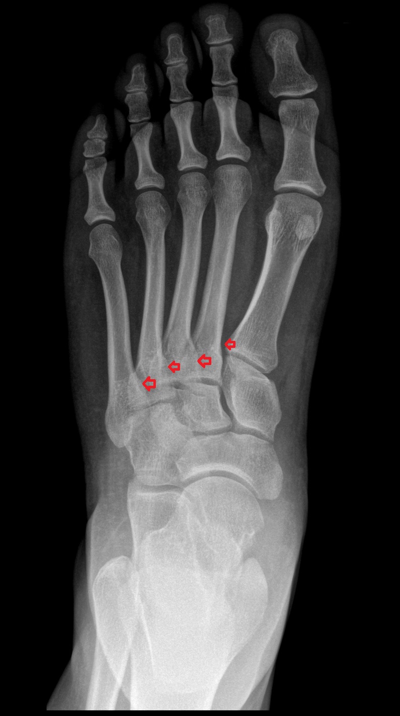 Intermetatarsal joints