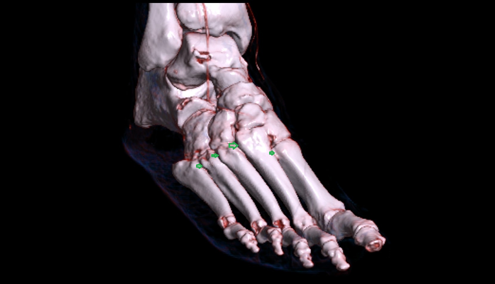 Intermetatarsal joints 3d