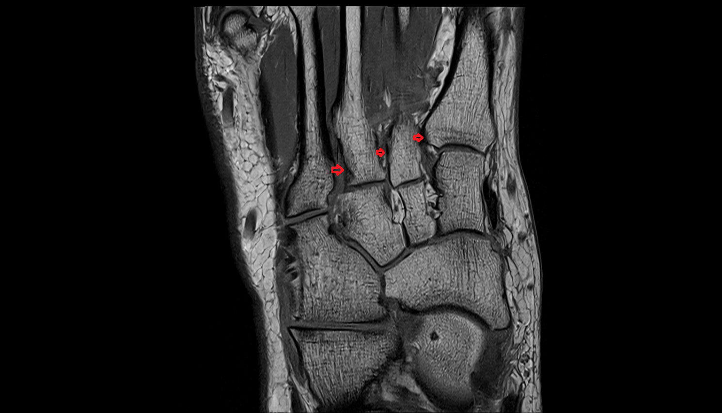 Intermetatarsal joints  mri  anatomy labelled image-img-00000-00000