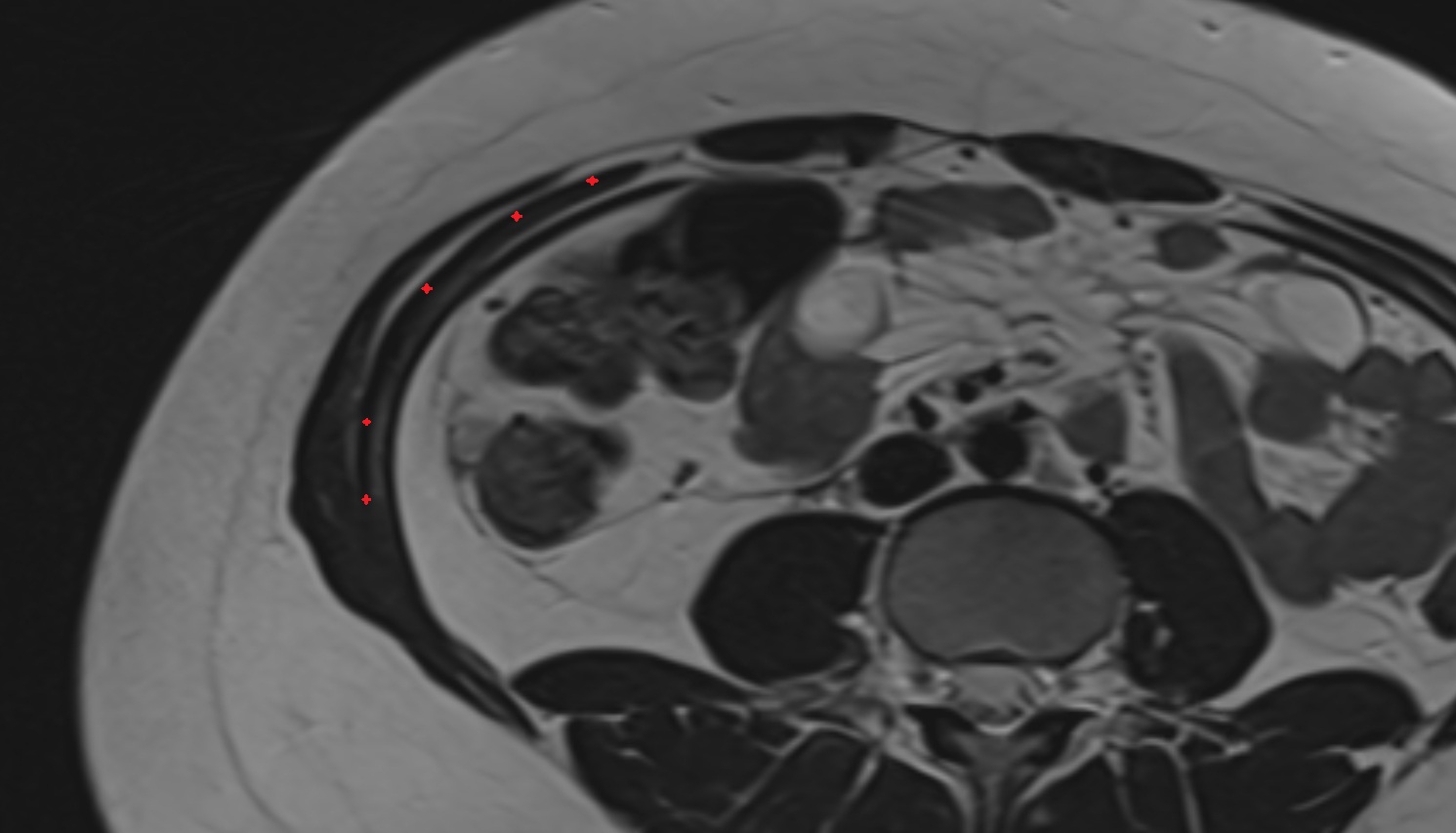 Internal Oblique Muscle   MRI axial  image anatomy  image -img-00000-00000