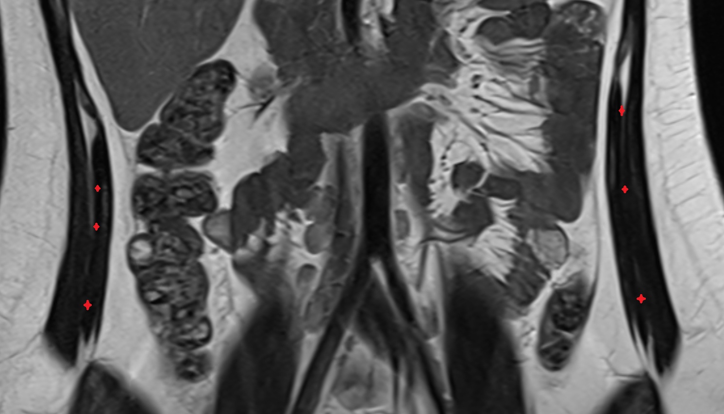 Internal Oblique Muscle  MRI  coronal image anatomy  image -img-00000-00000