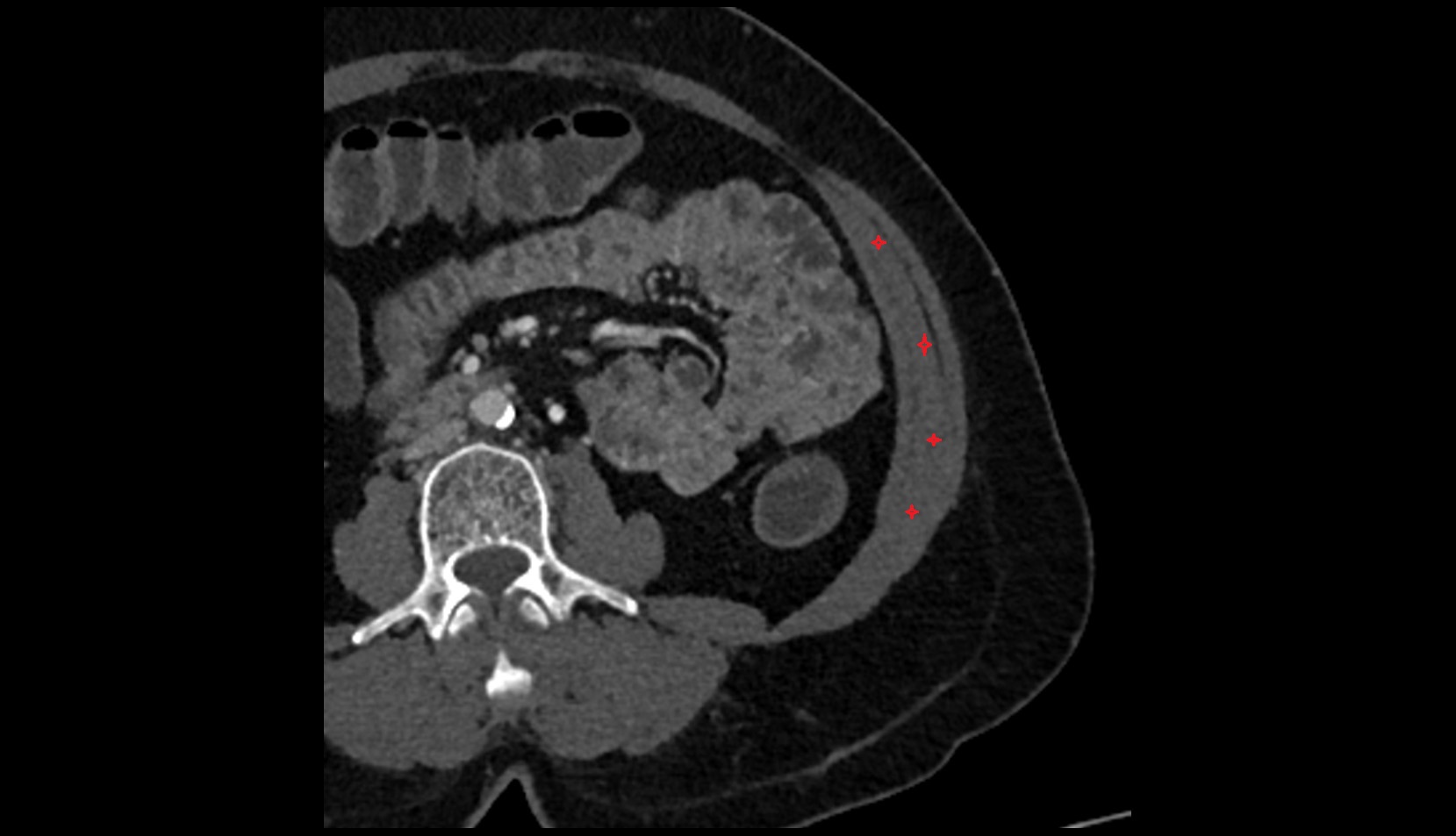 Internal Oblique Muscle axial ct image