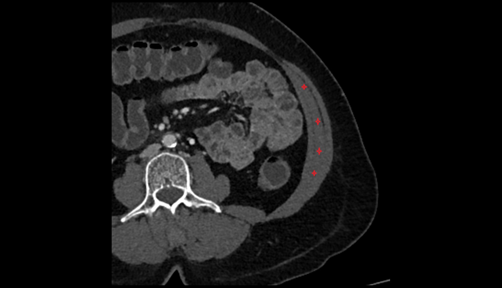 Internal Oblique Muscle axial ct image 2