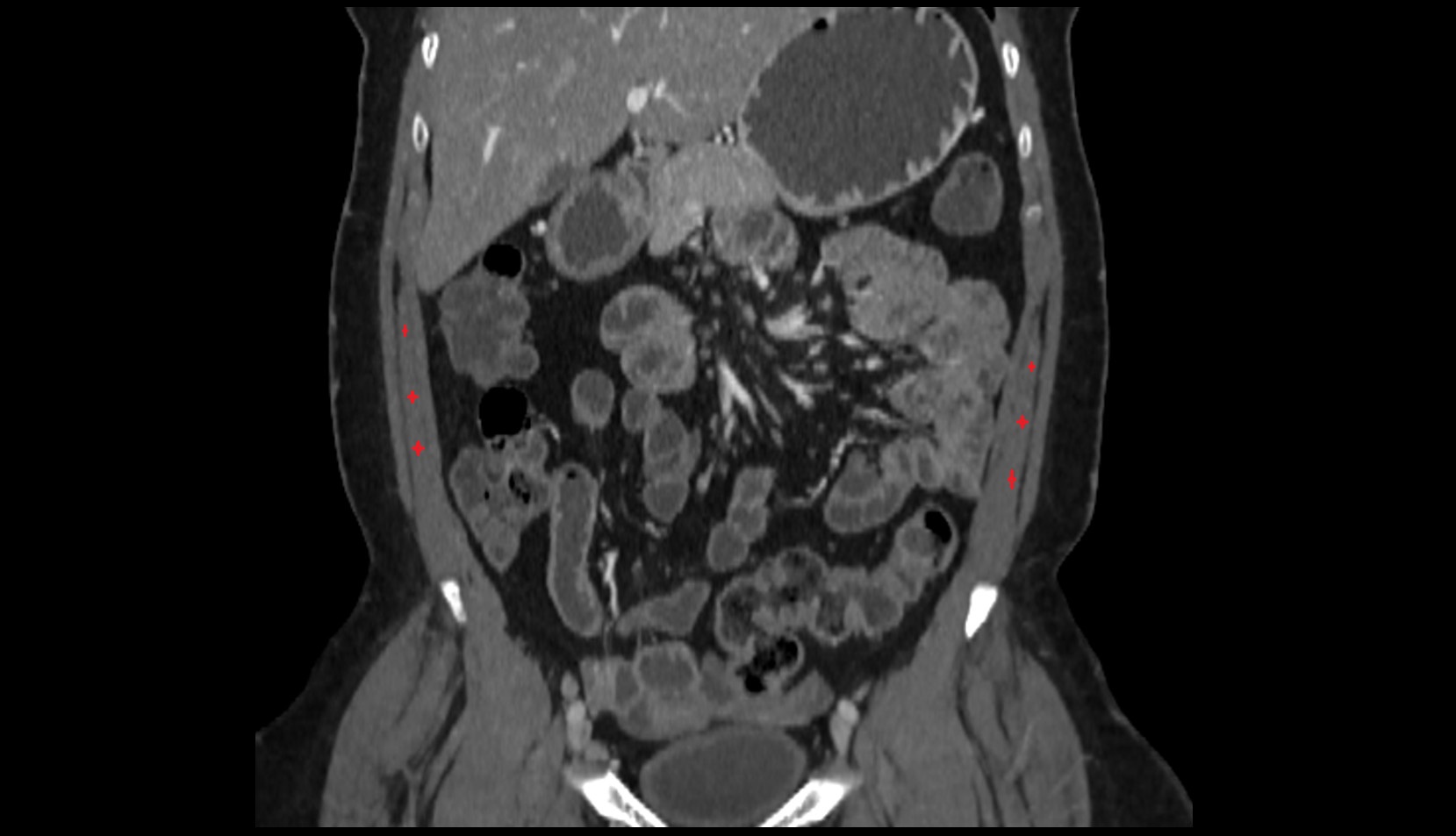 Internal Oblique Muscle coronal ct image