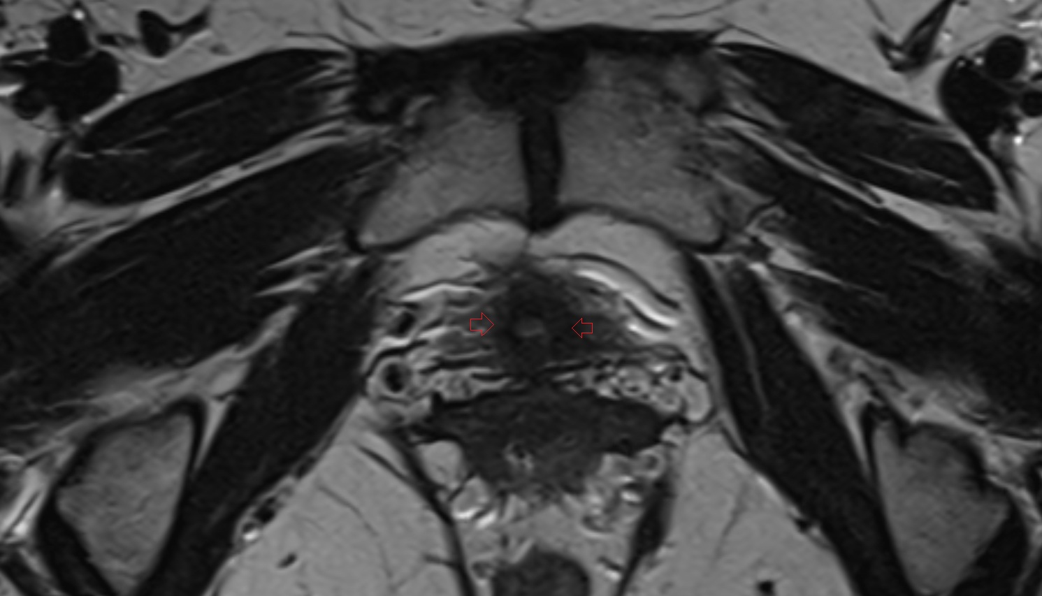 Internal Urethral Sphincter (Female)   MRI axial  anatomy  image-img-00000-00000