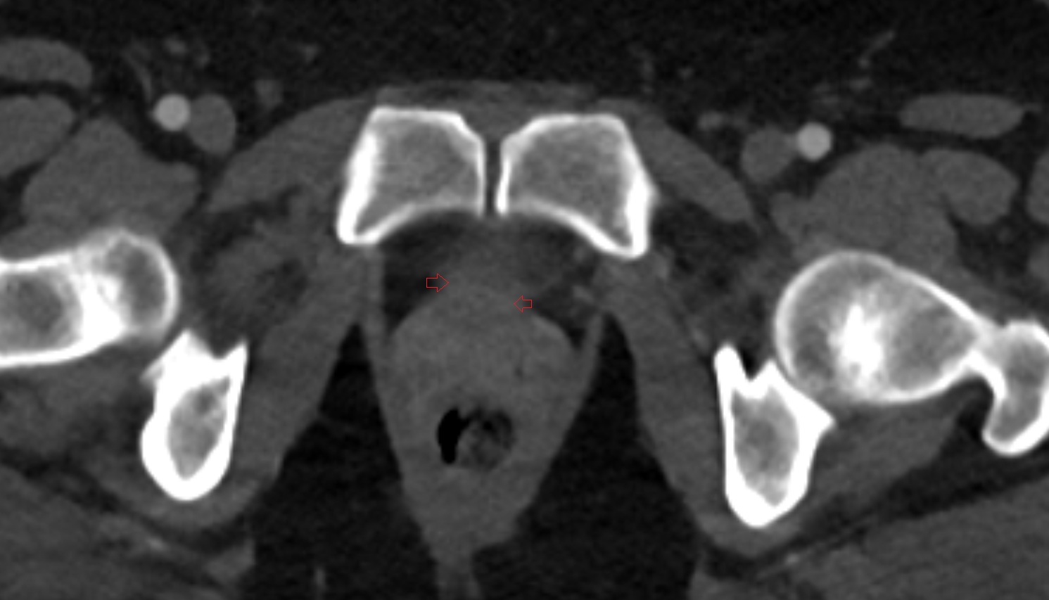 Internal Urethral Sphincter (Female)   ct  axial  anatomy  image-img-00000-00000