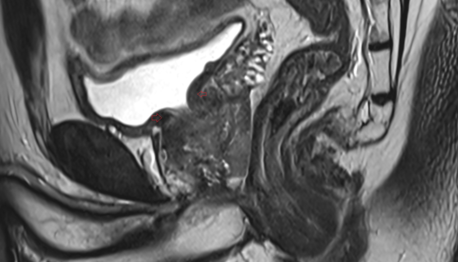 Internal Urethral Sphincter (Male)   MRI  SAG  anatomy  image-img-00000-00000