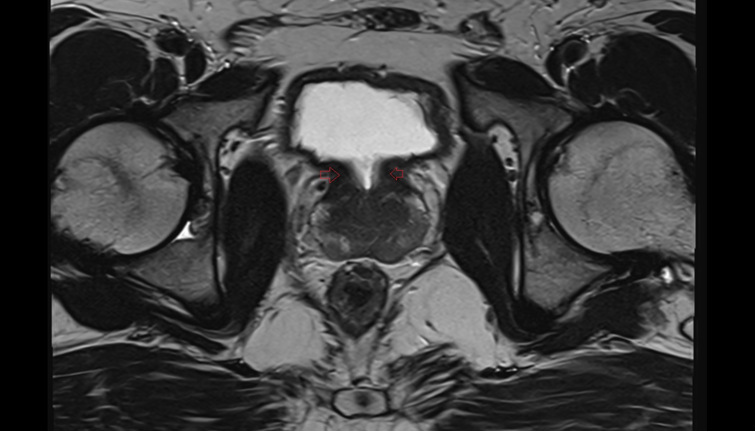 Internal Urethral Sphincter (Male)   MRI  axial  anatomy  image-img-00000-00000