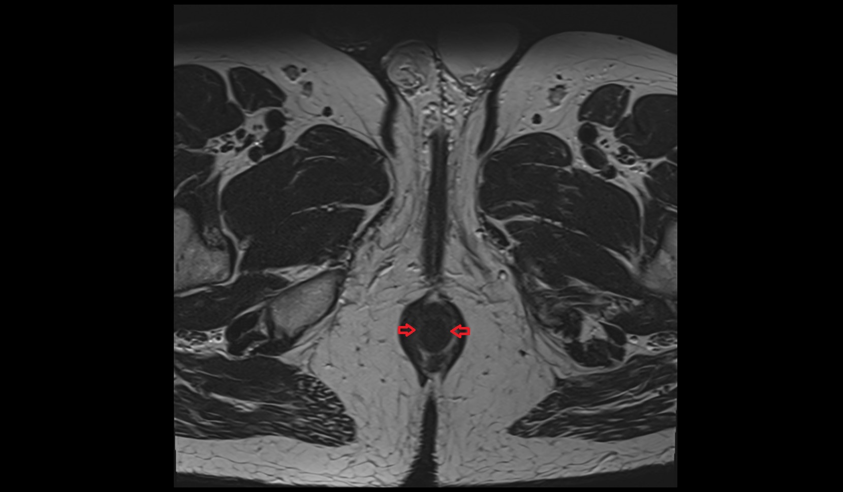 Internal anal sphincter