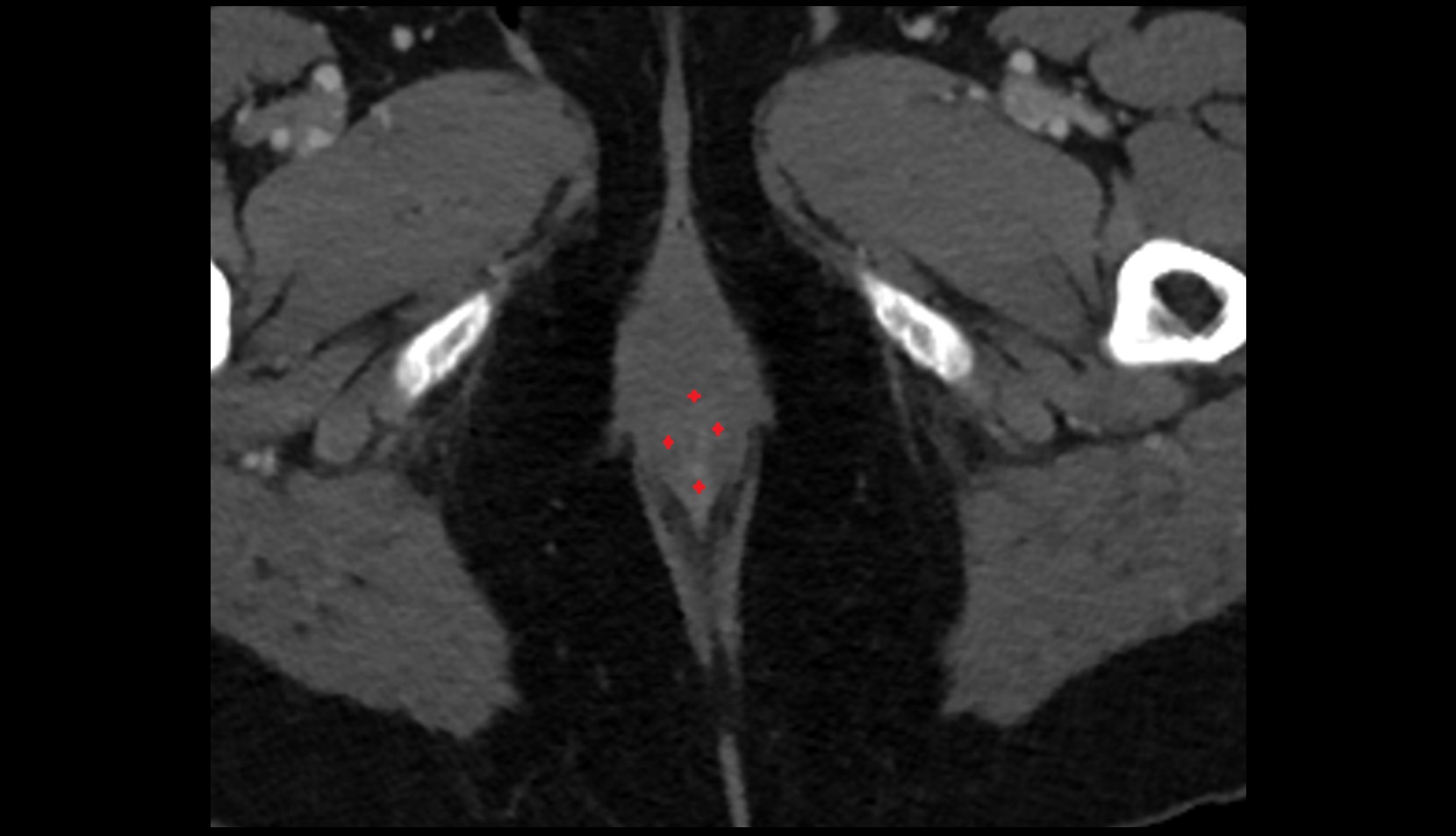 Internal anal sphincter ct axial image