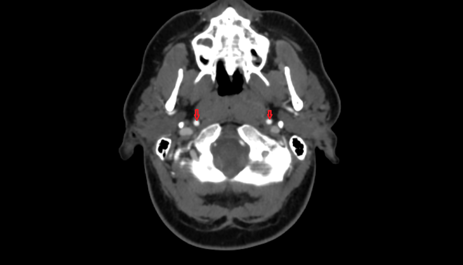 Internal carotid artery CT axial  image-img-00000-00000