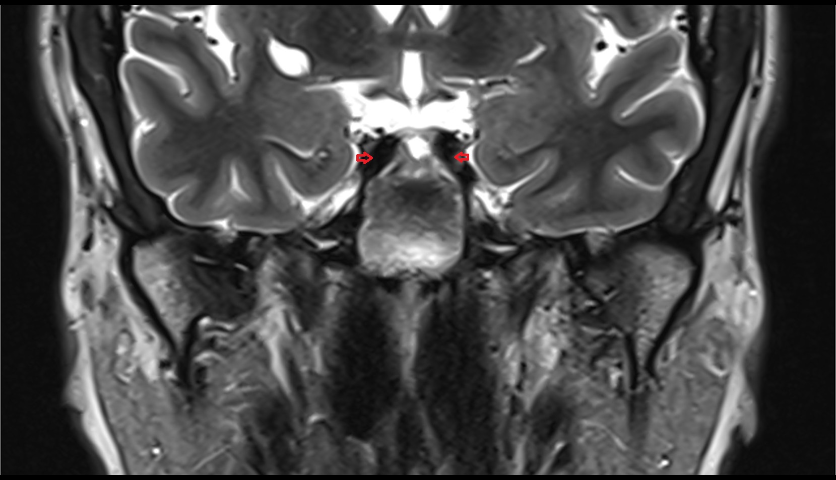 Internal carotid artery (cavernous part) coronal image