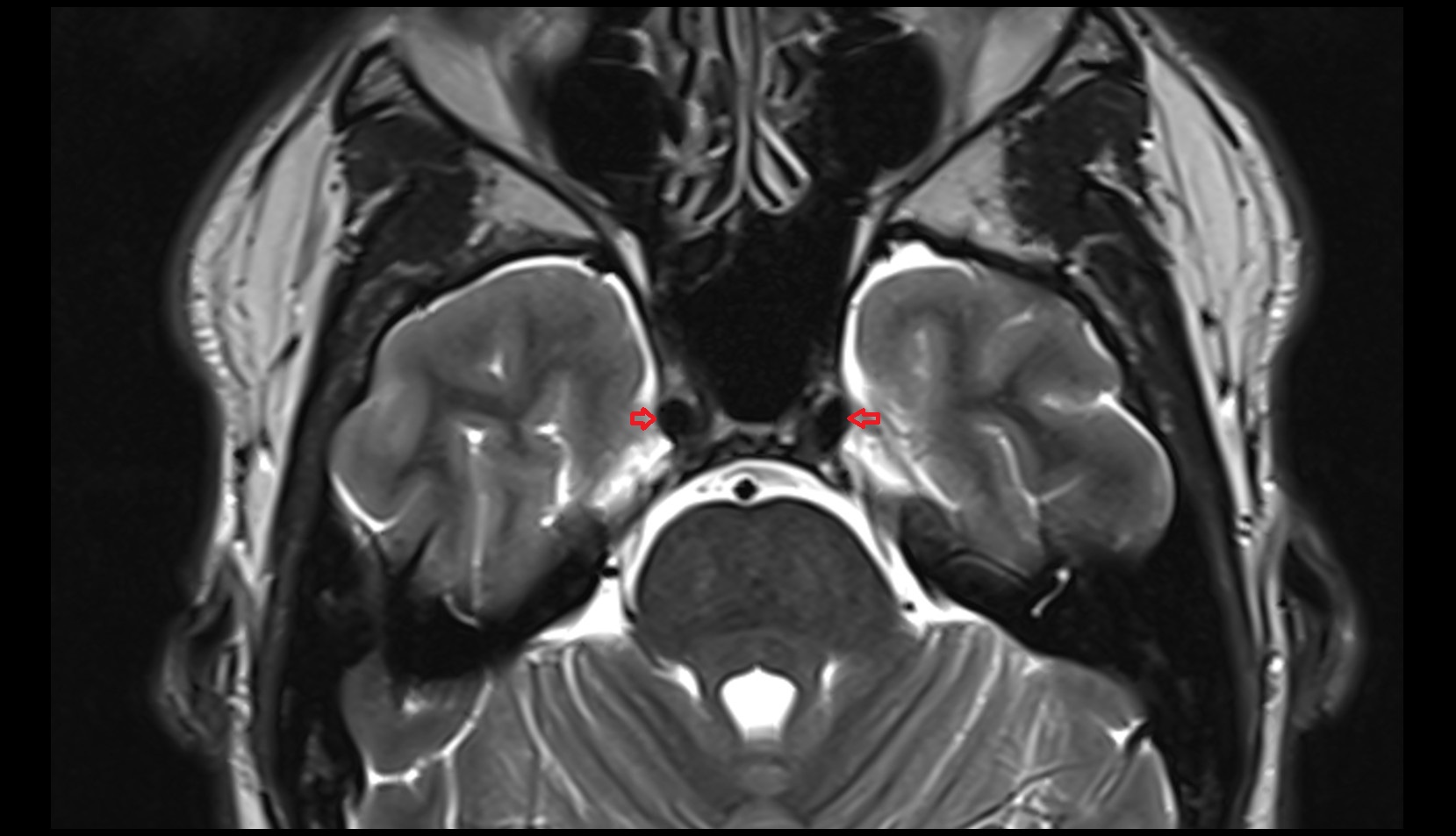 Internal carotid artery (cavernous part) mri axial image