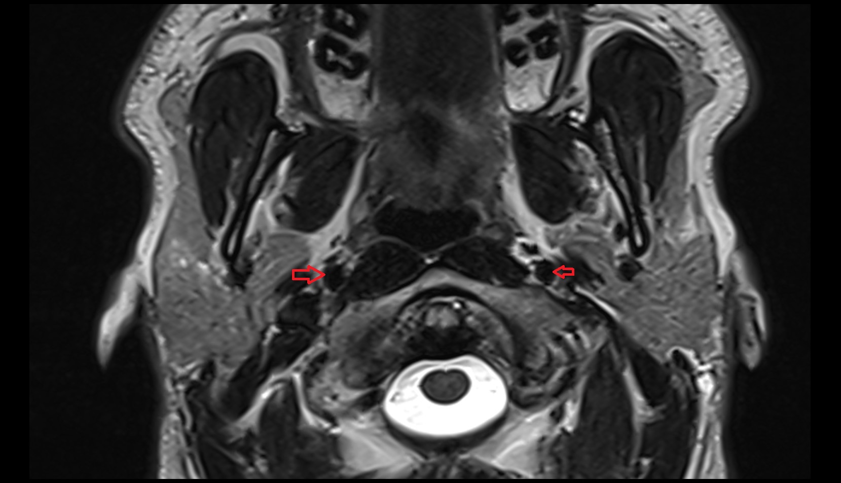 Internal carotid artery (cervical part) axial image