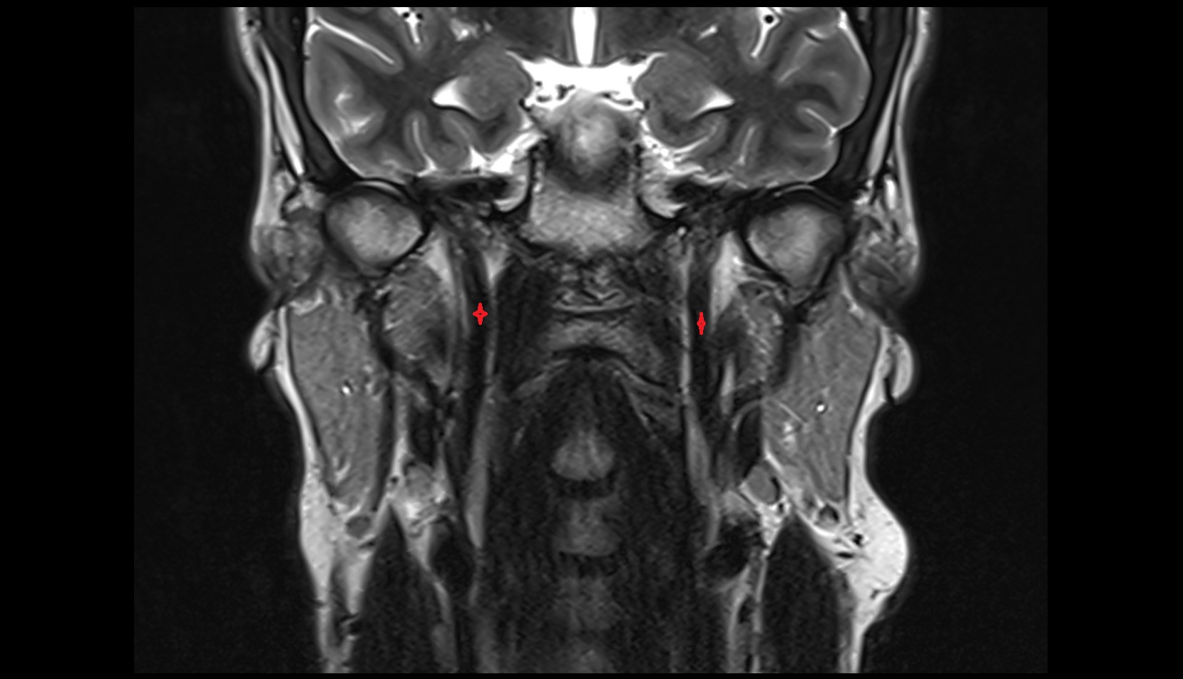 Internal carotid artery (cervical part) mri coronal image