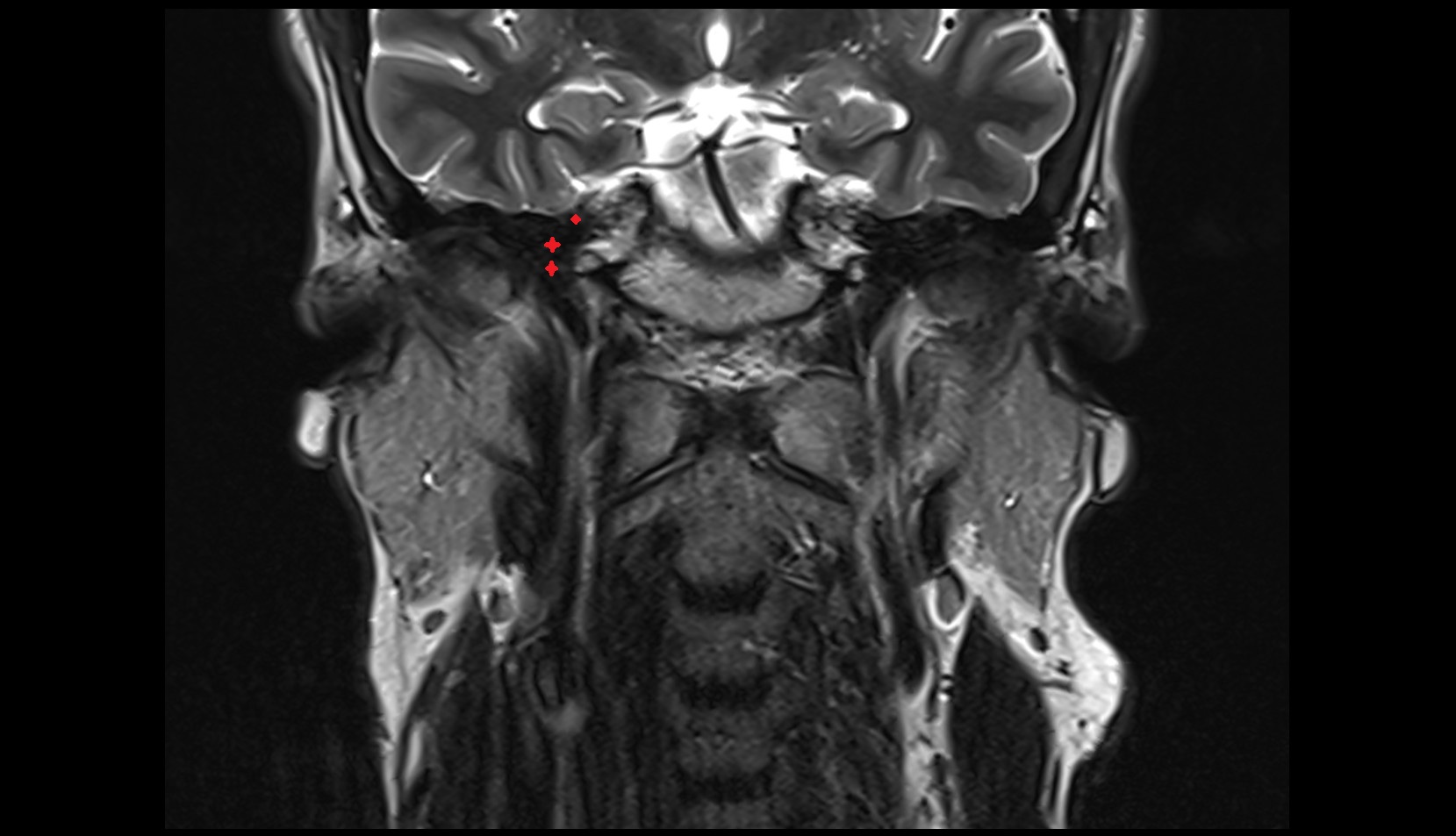 Internal carotid artery (petrous part) coronal image