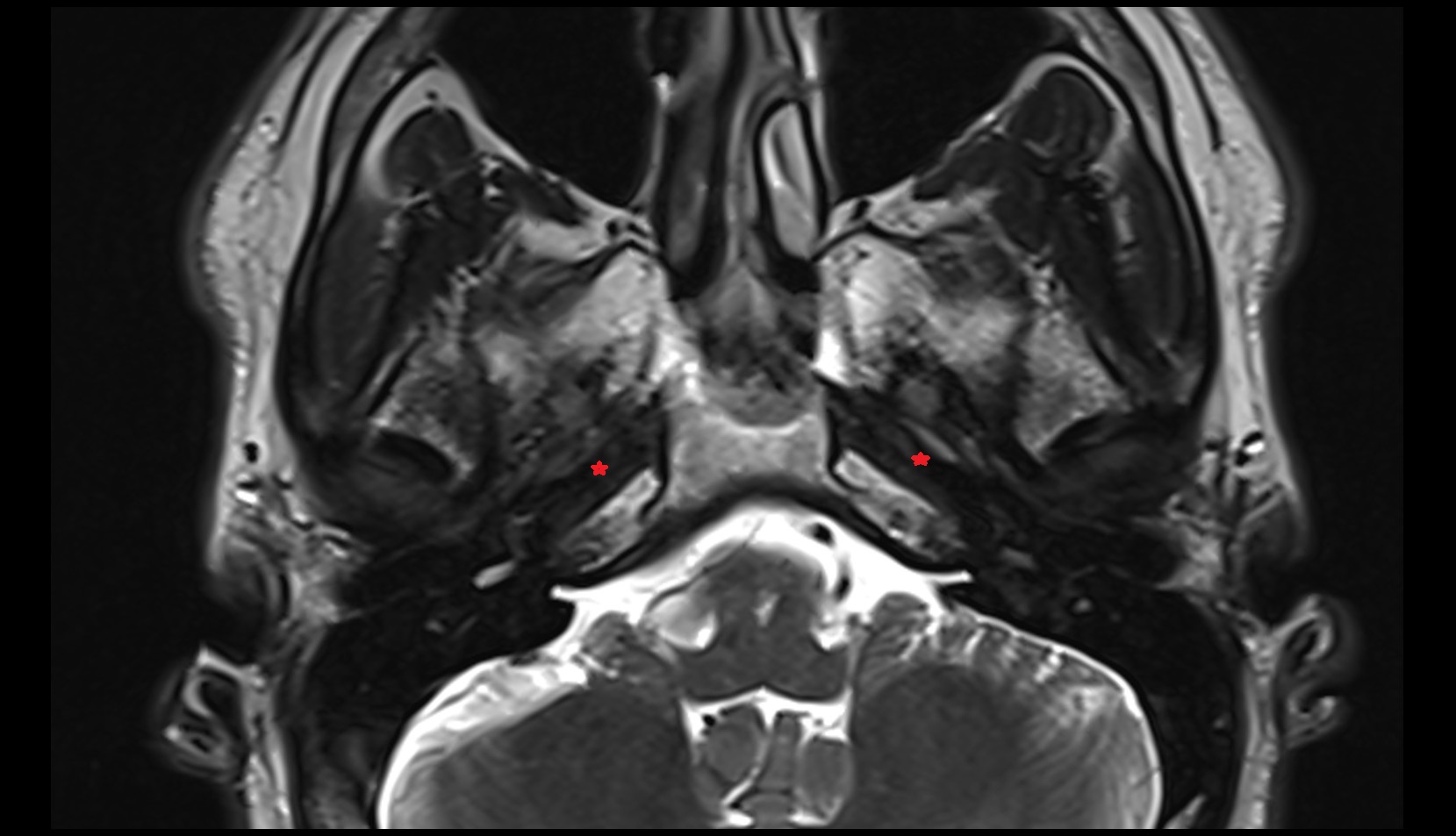 Internal carotid artery (petrous part) mri axial image