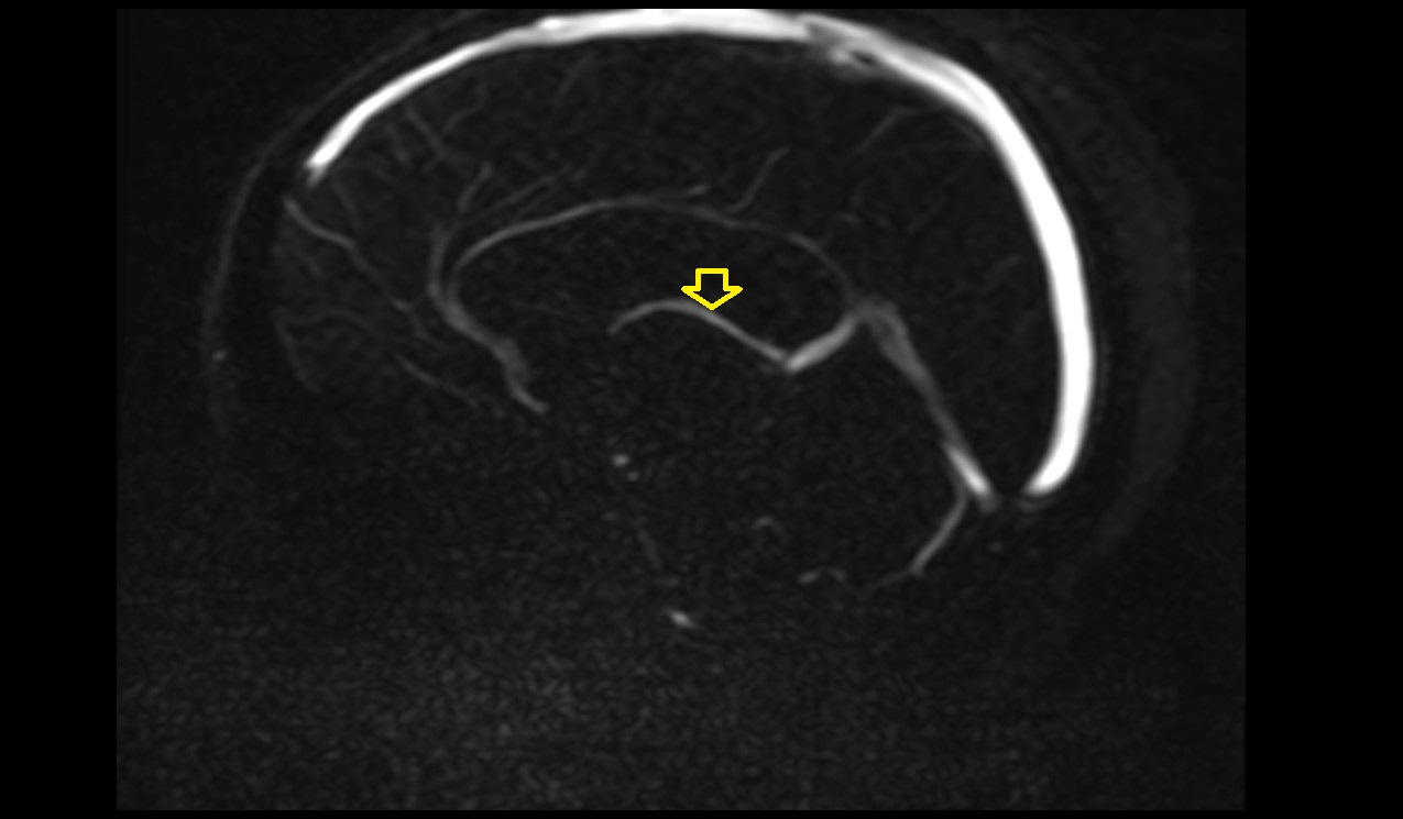 Internal cerebral veins MRI 3T PC 3D image