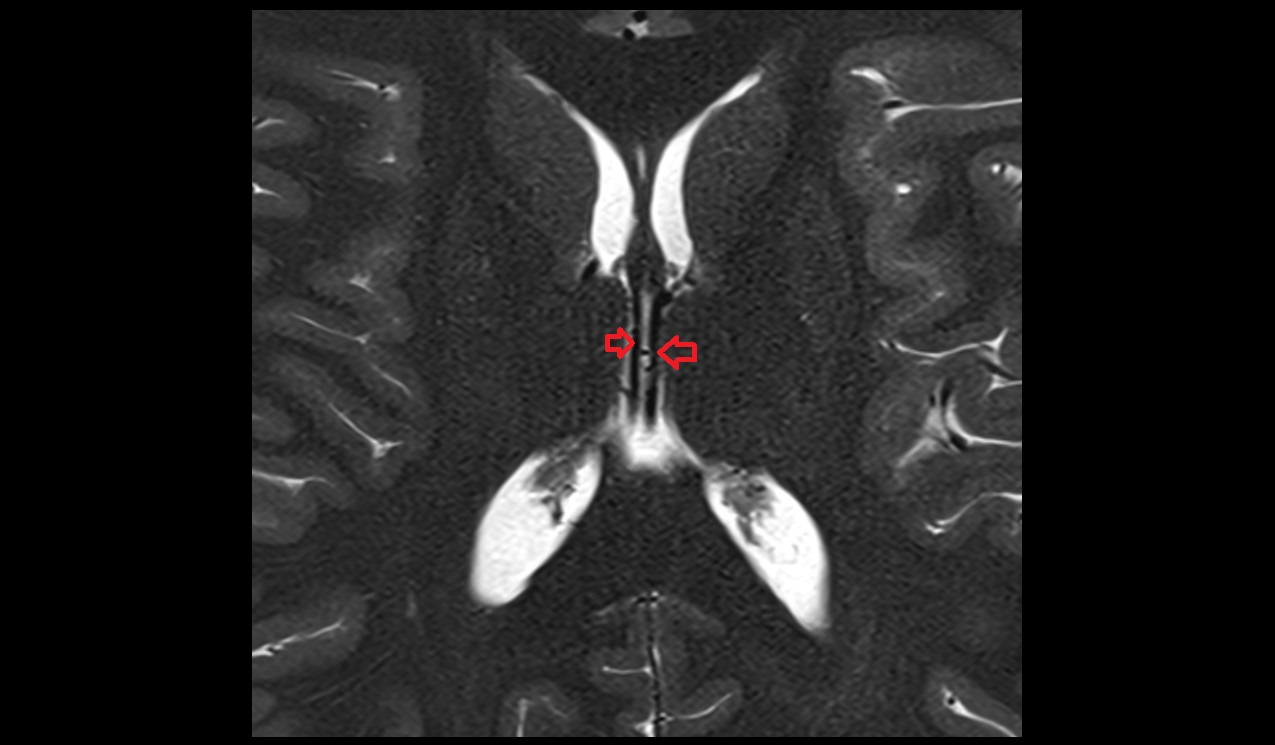 Internal cerebral veins MRI 3T axial image